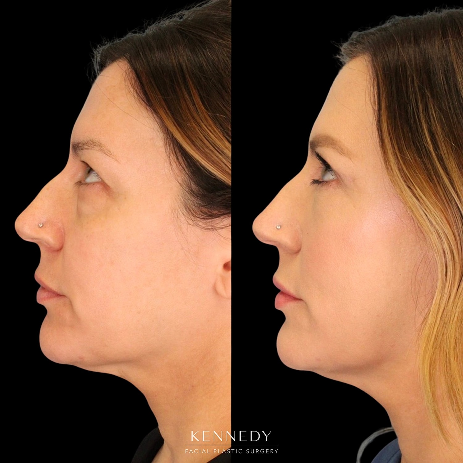 Facial Fat Transfer Before & After