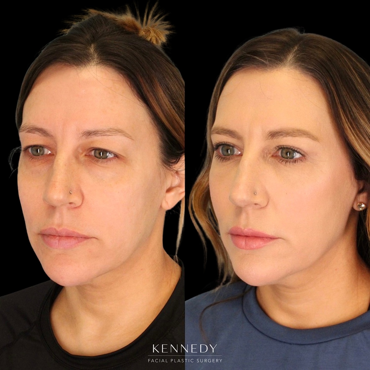 Facial Fat Transfer Before & After