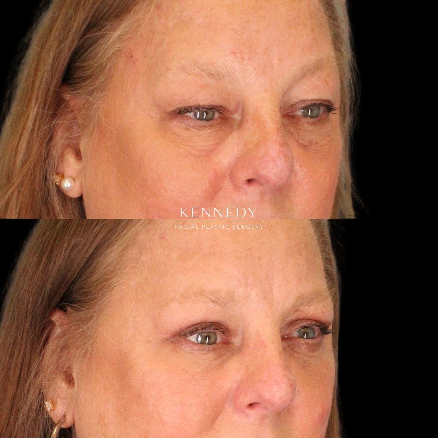 Facial Fat Transfer Before & After