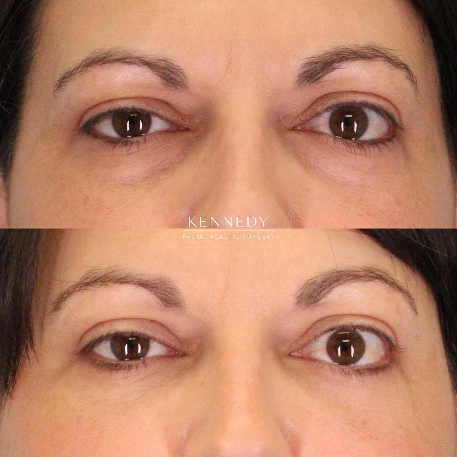 Facial Fat Transfer Before & After