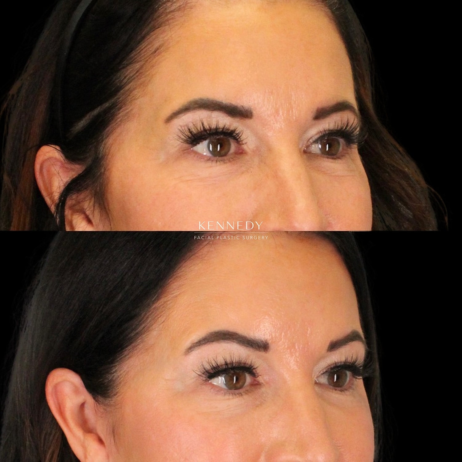 Facial Fat Transfer Before & After