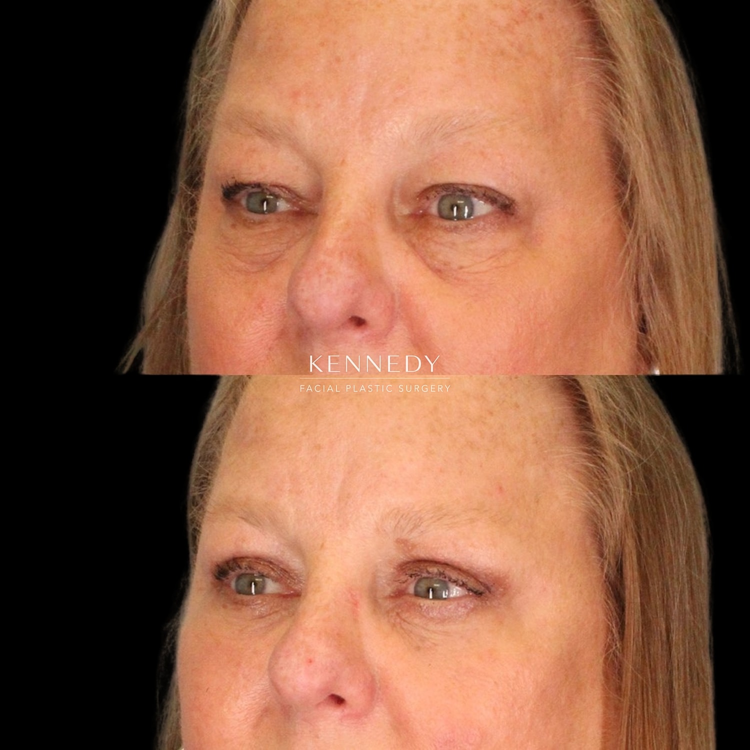 Facial Fat Transfer Before & After