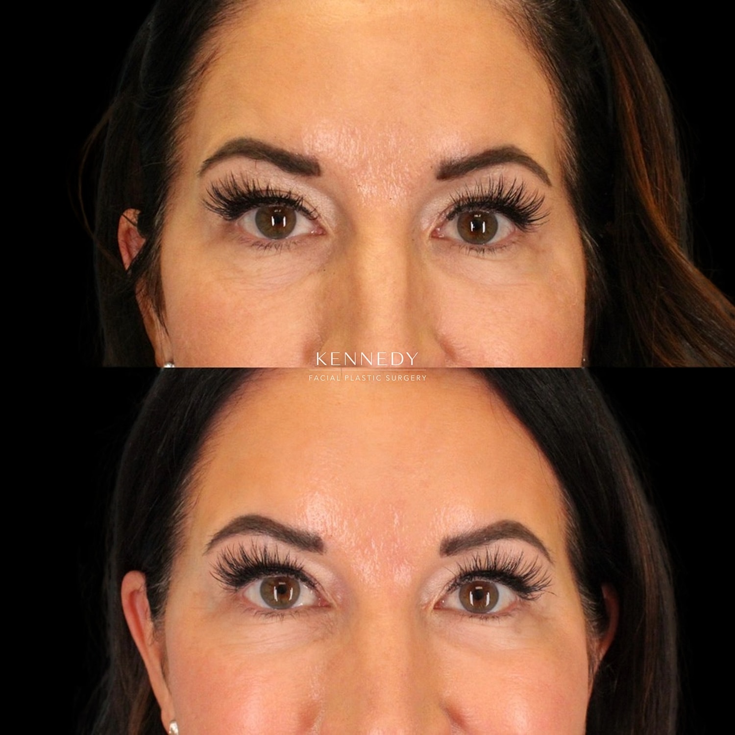 Facial Fat Transfer Before & After
