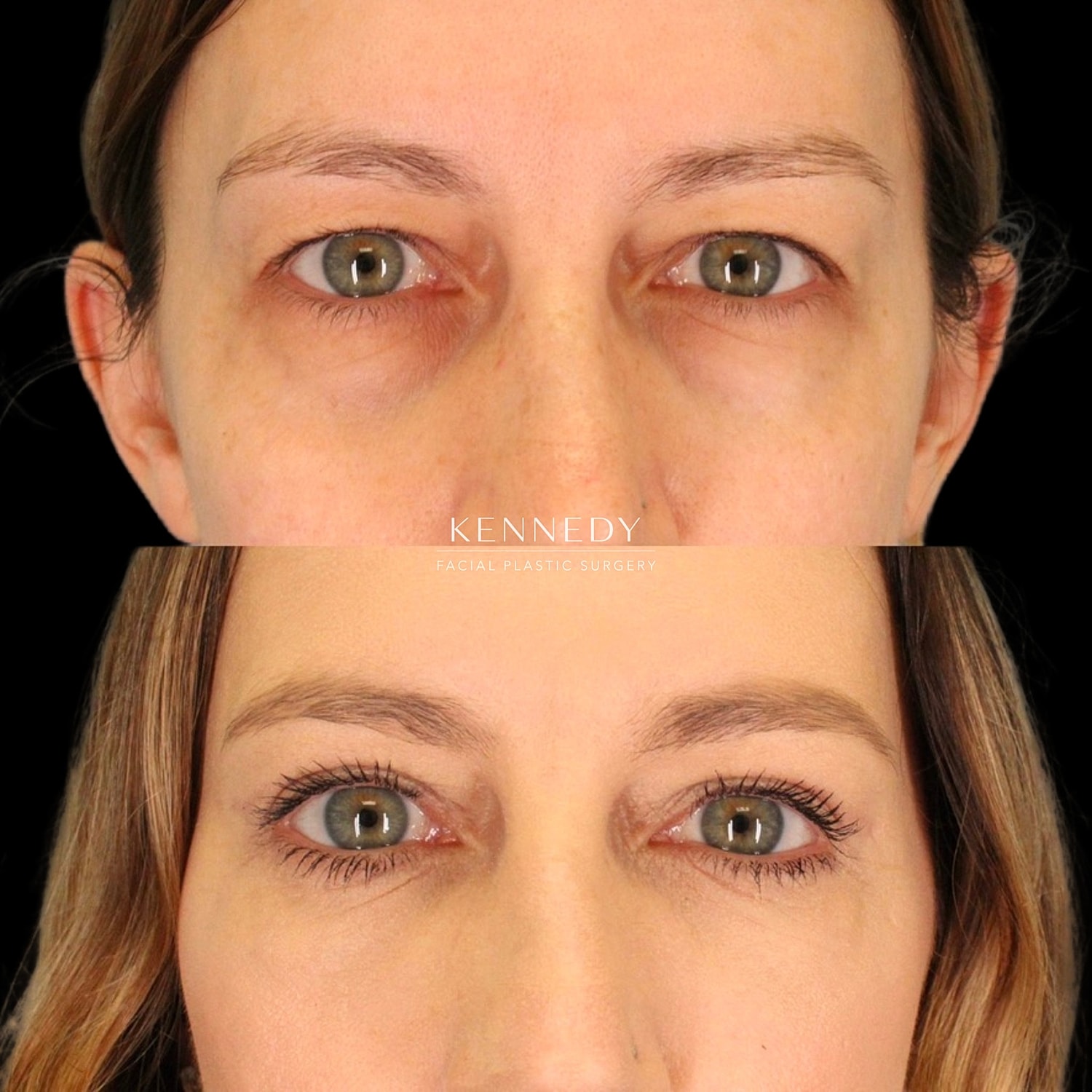 Facial Fat Transfer Before & After