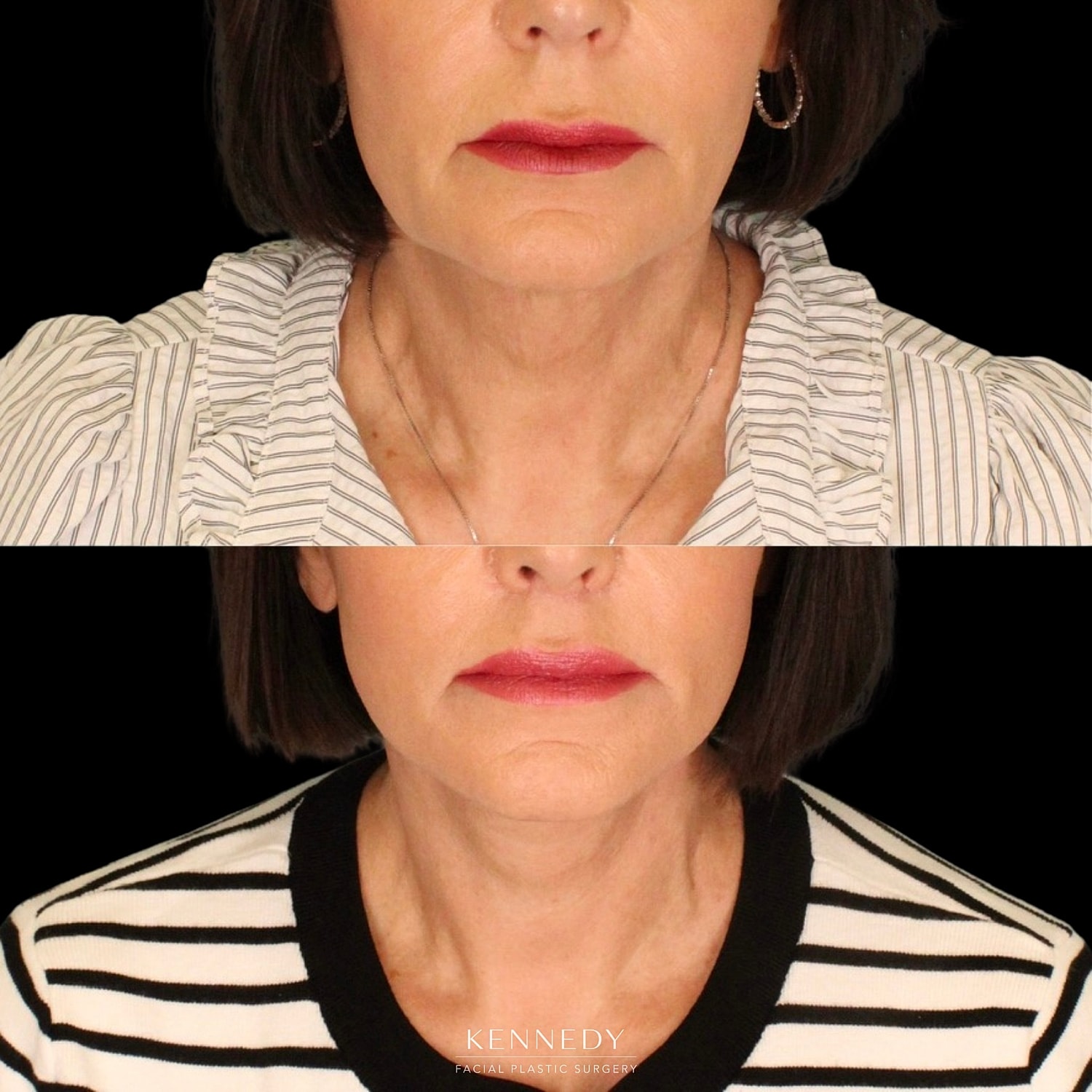 Lip Lift Before & After