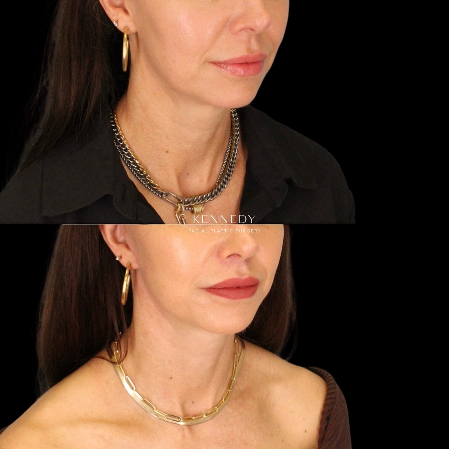Lip Lift Before & After