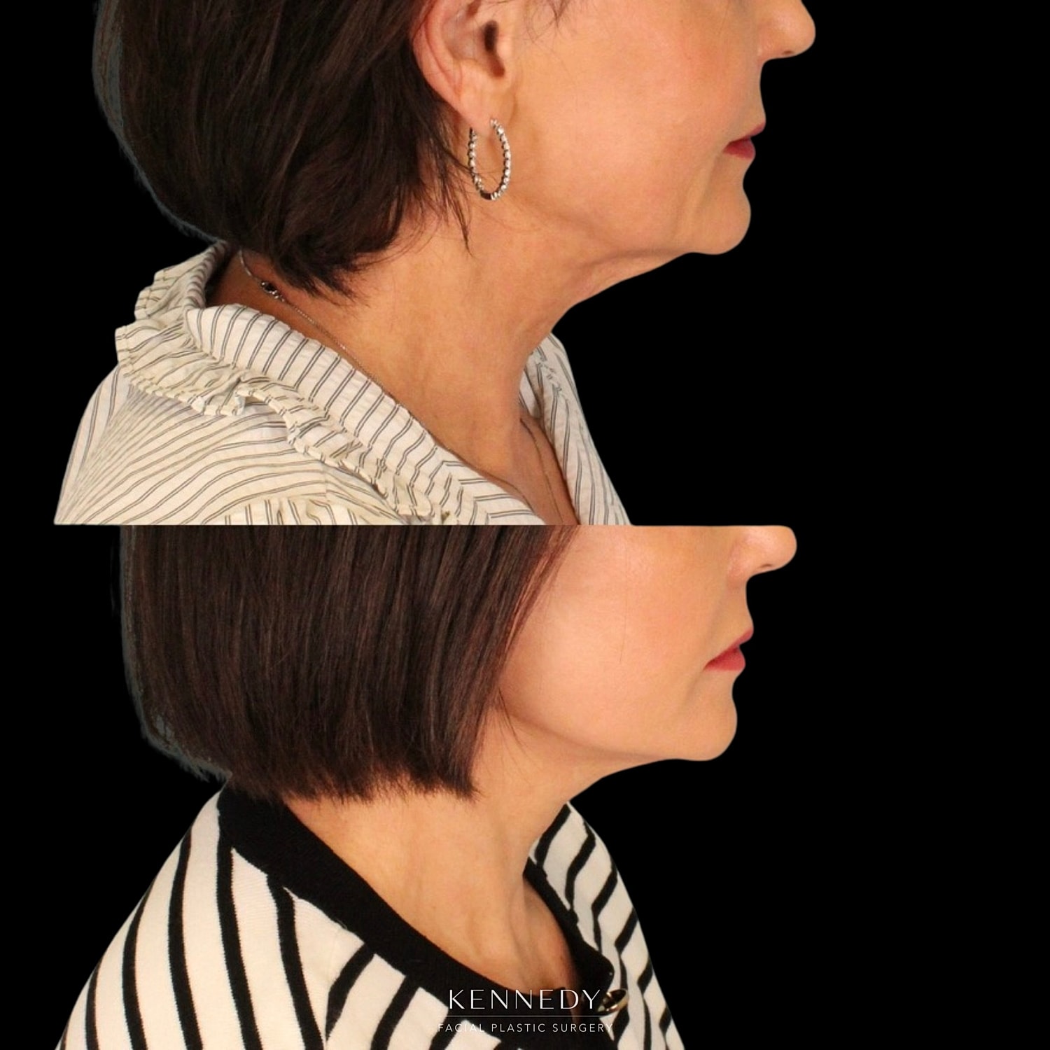 Lip Lift Before & After