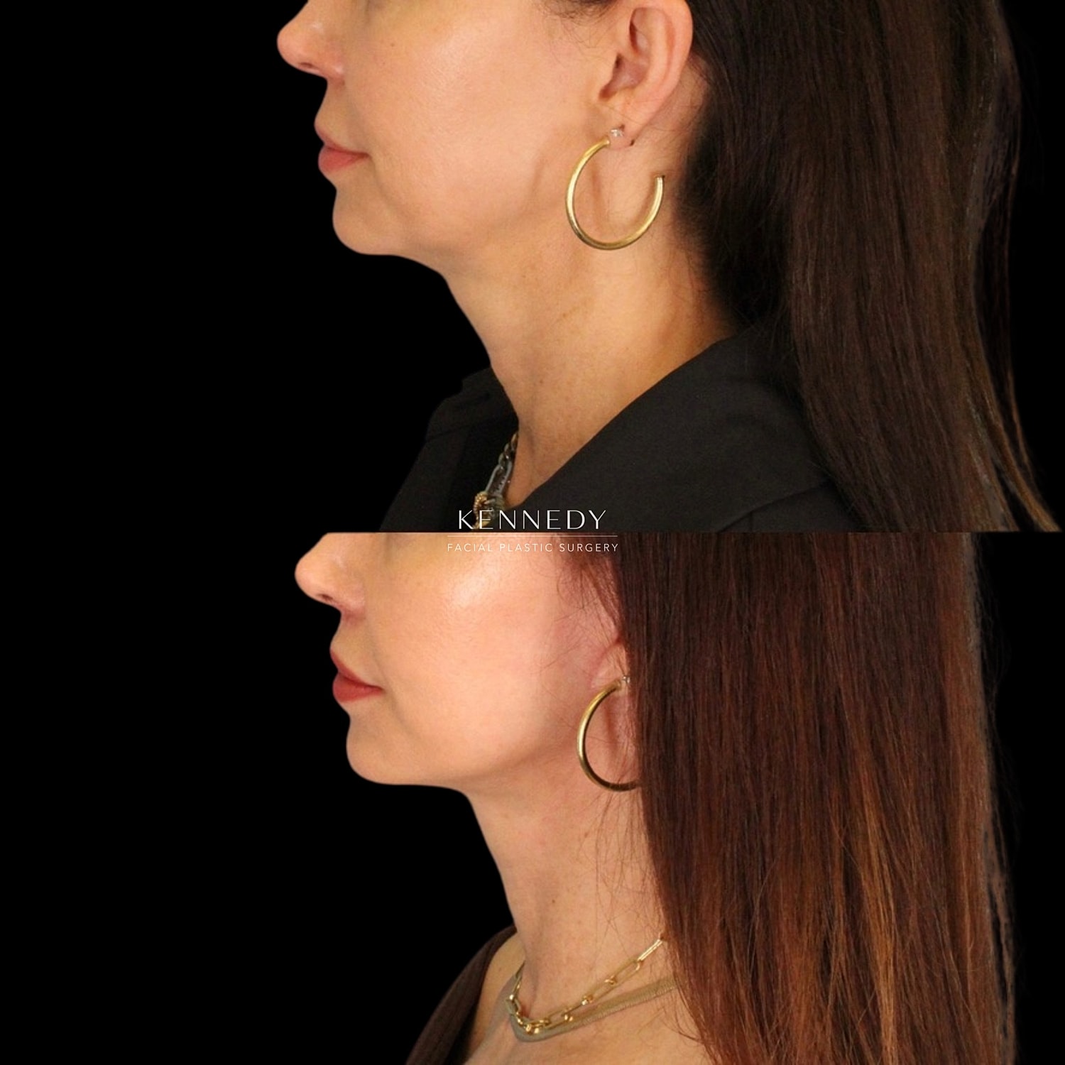 Lip Lift Before & After
