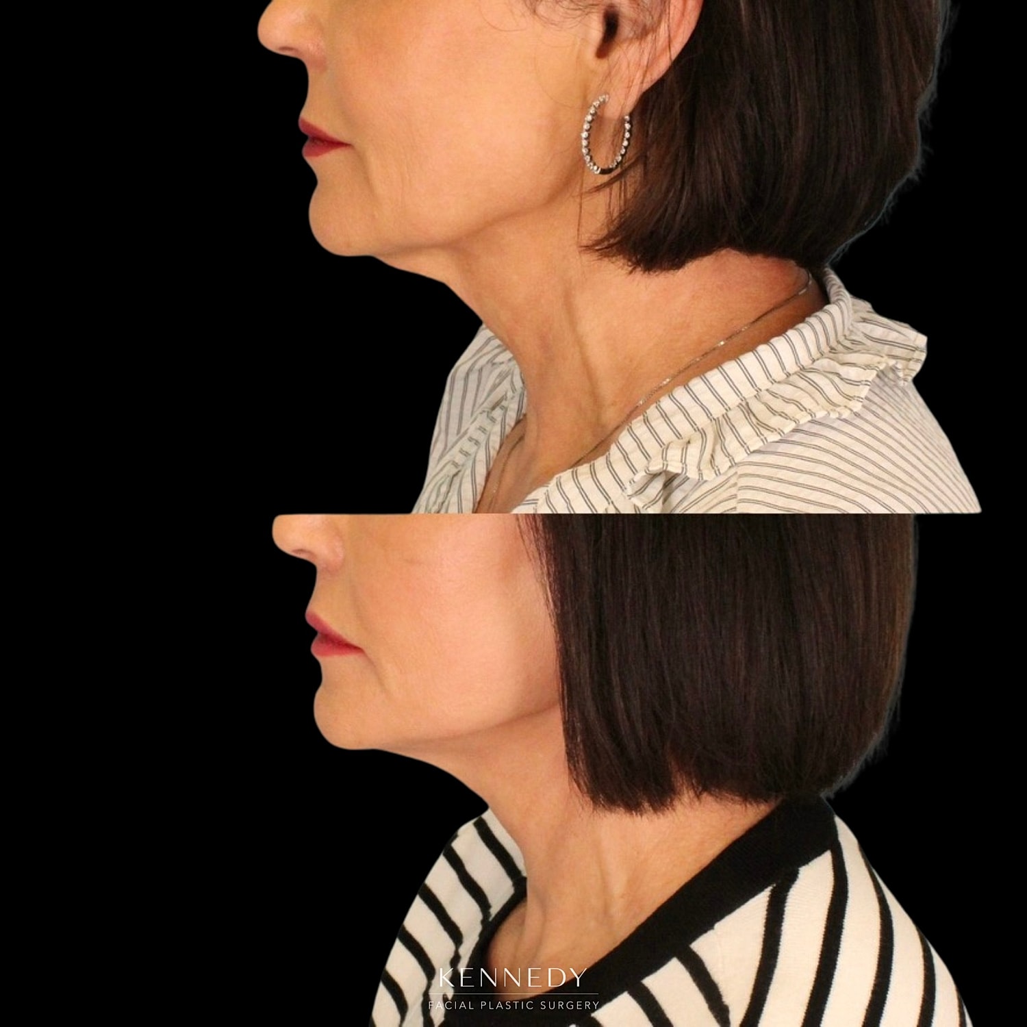 Lip Lift Before & After
