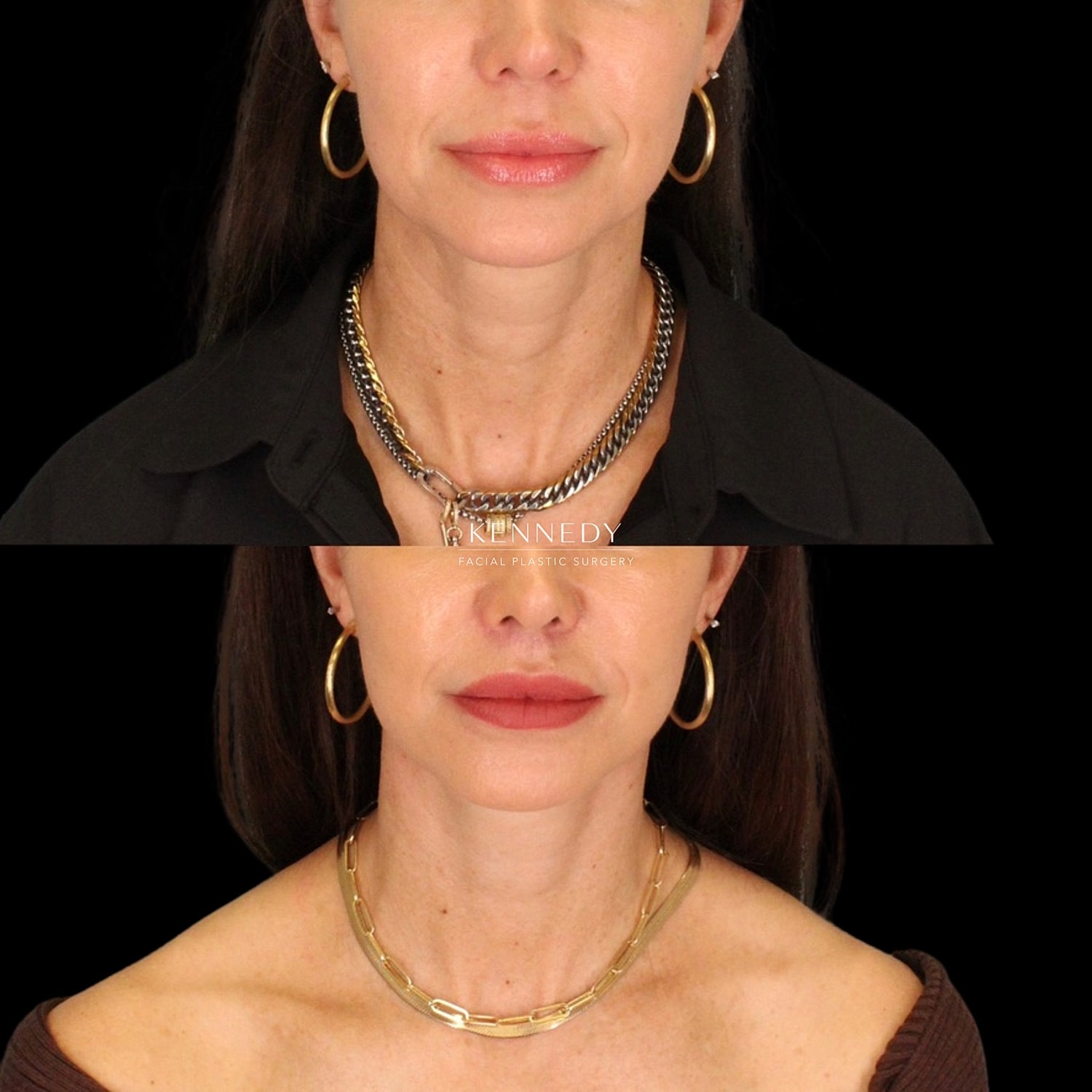Lip Lift Before & After
