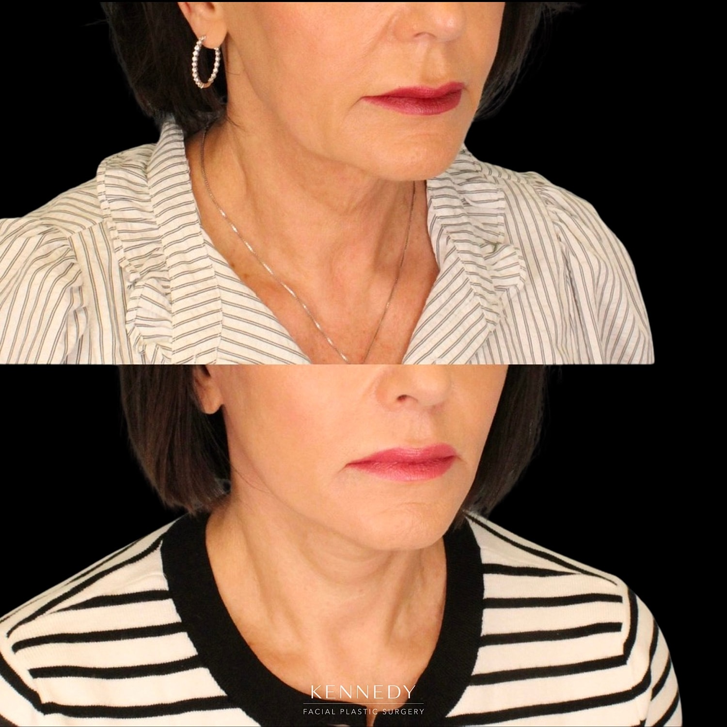Lip Lift Before & After