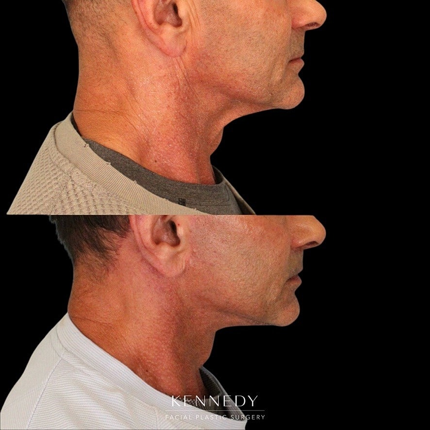 Lip Lift Before & After