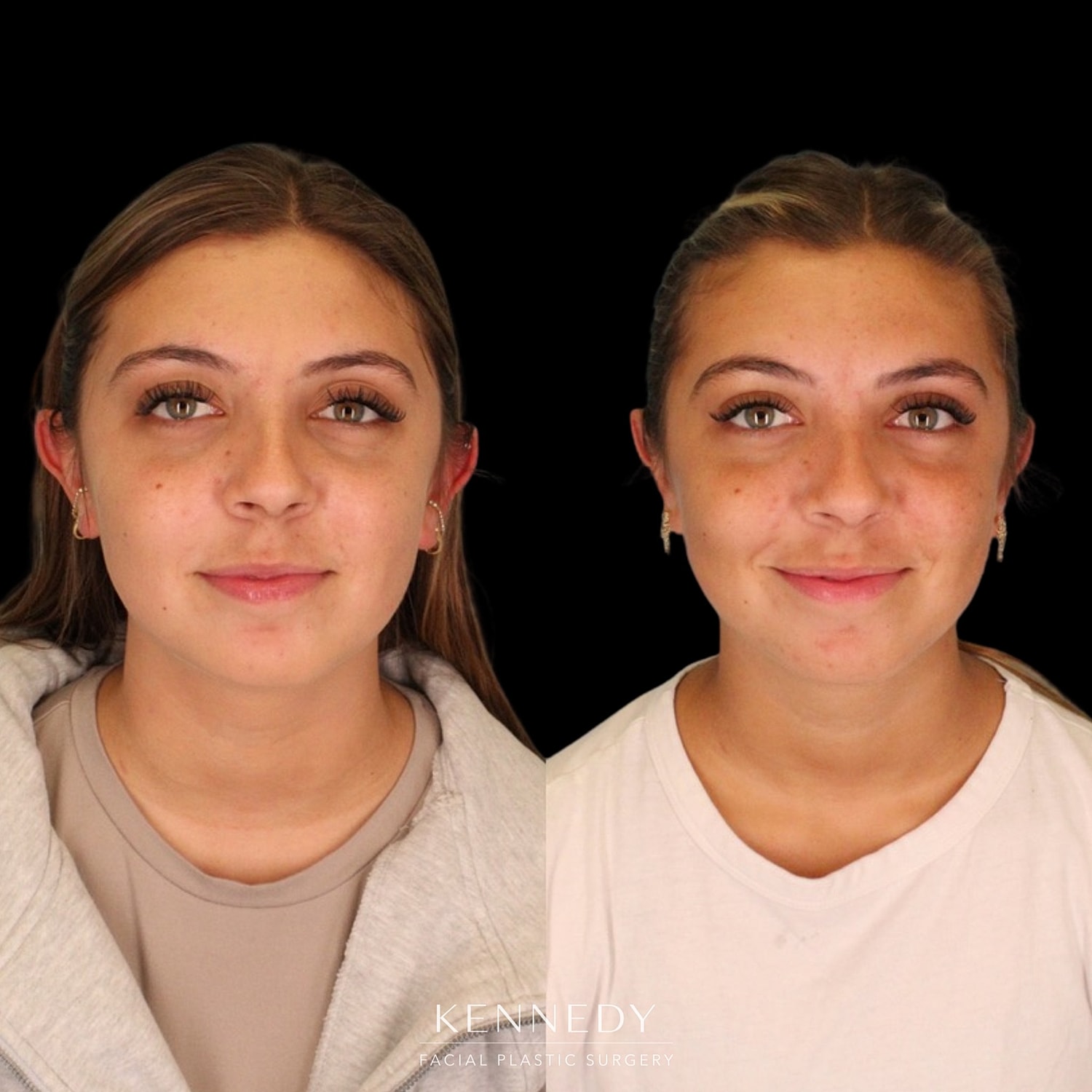 Otoplasty Before & After