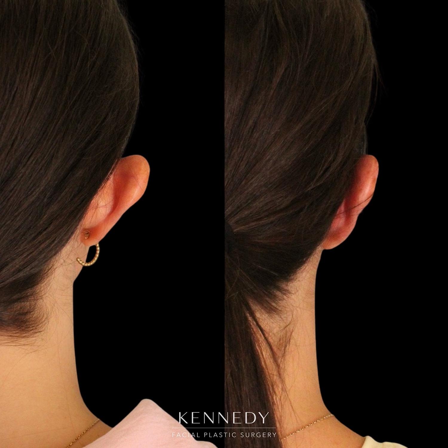 Otoplasty Before & After