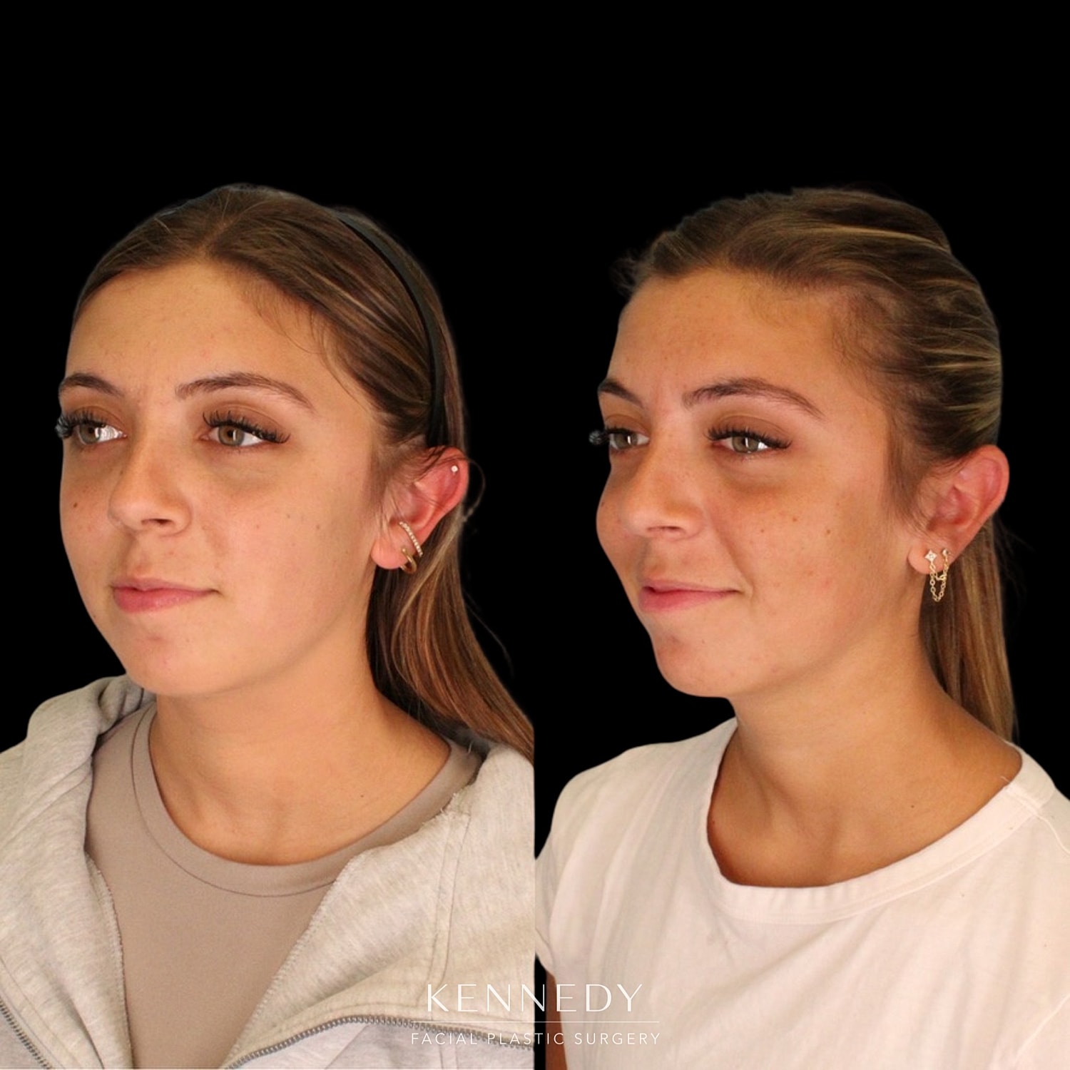 Otoplasty Before & After