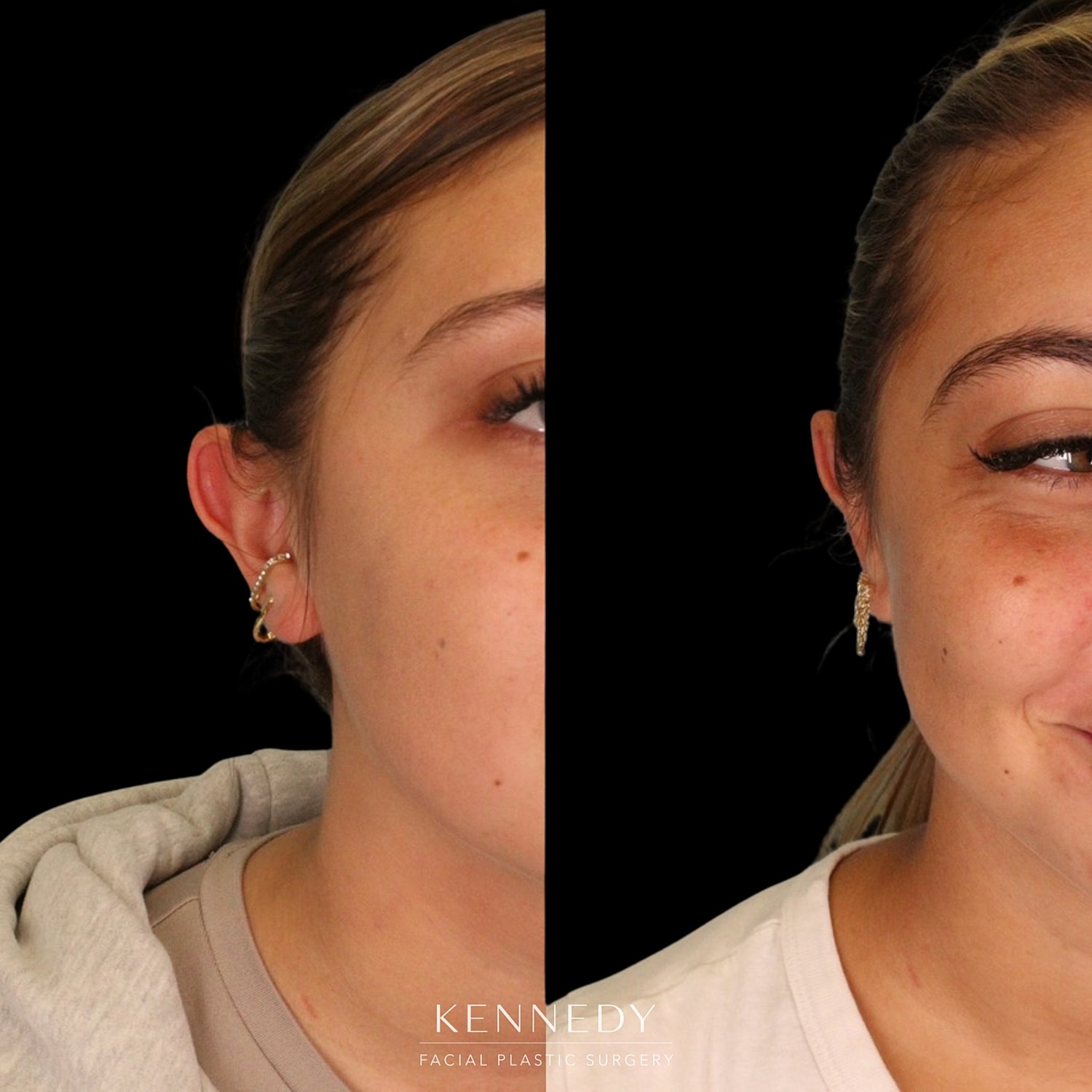 Otoplasty Before & After
