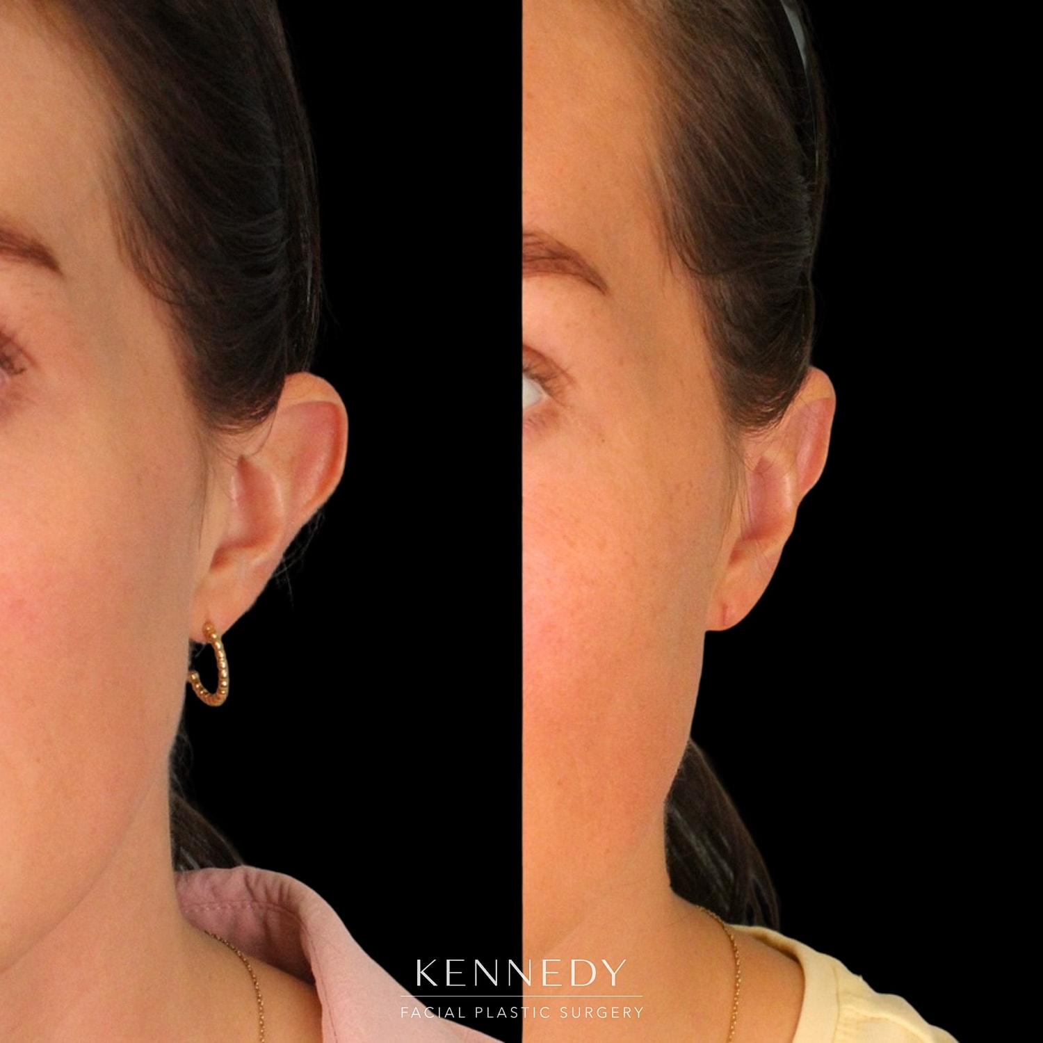 Otoplasty Before & After