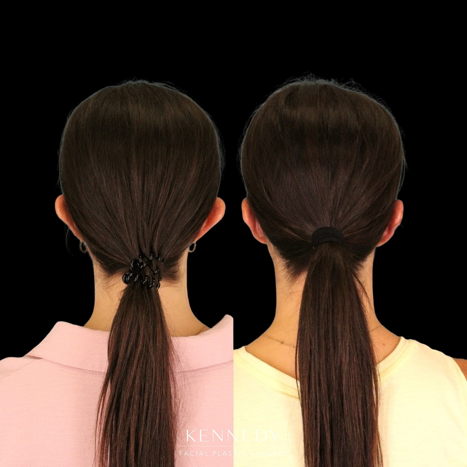 Otoplasty Before & After