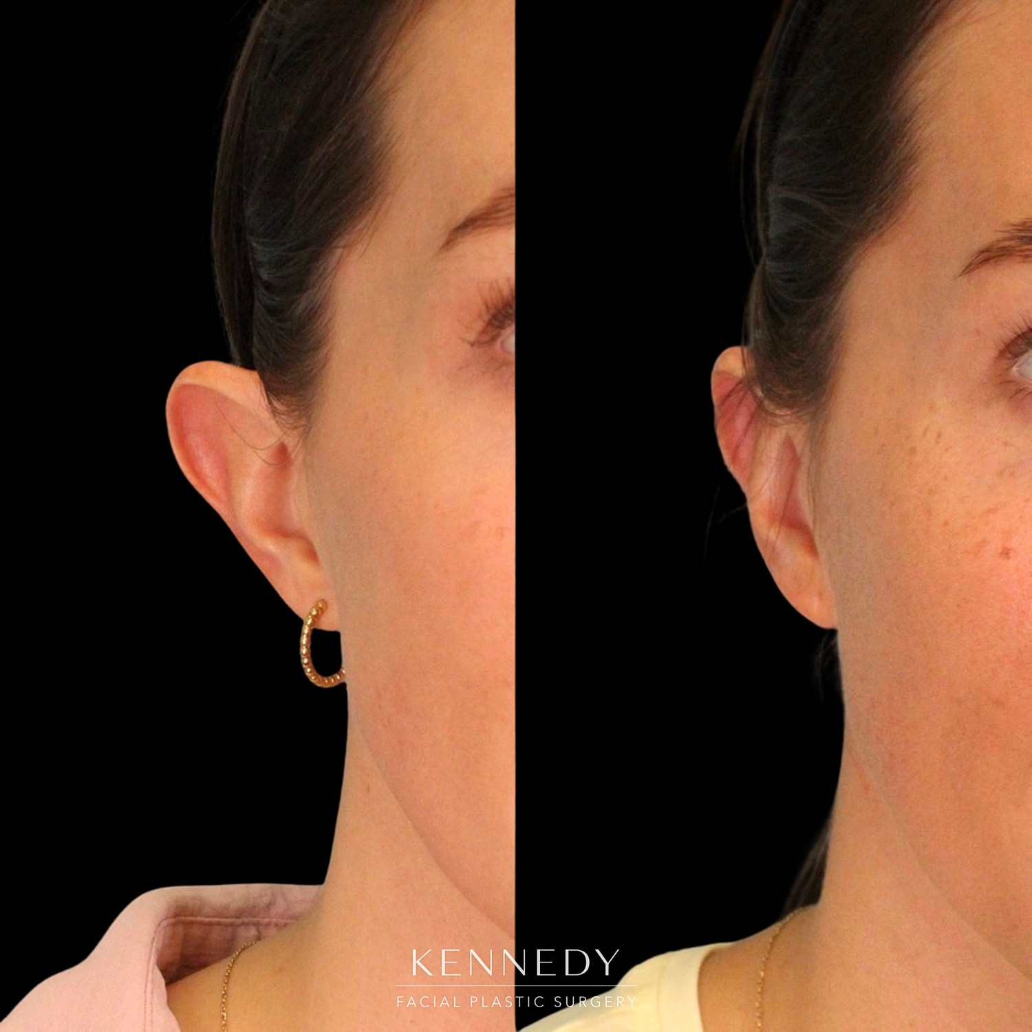 Otoplasty Before & After