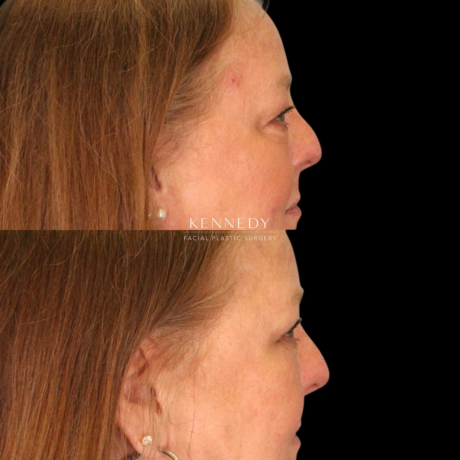 Lower Blepharoplasty Before & After