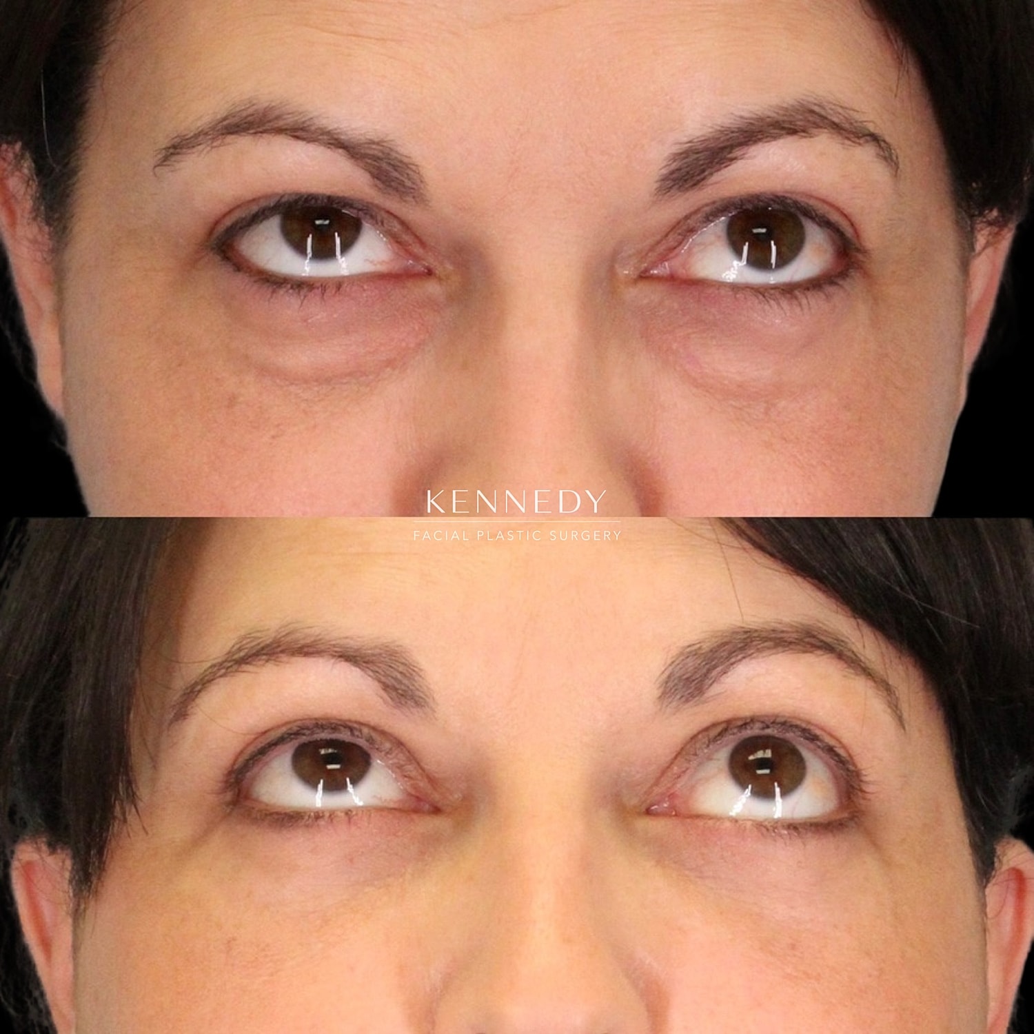 Lower Blepharoplasty Before & After