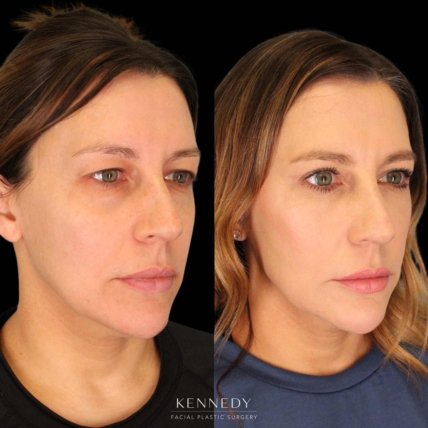Lower Blepharoplasty Before & After