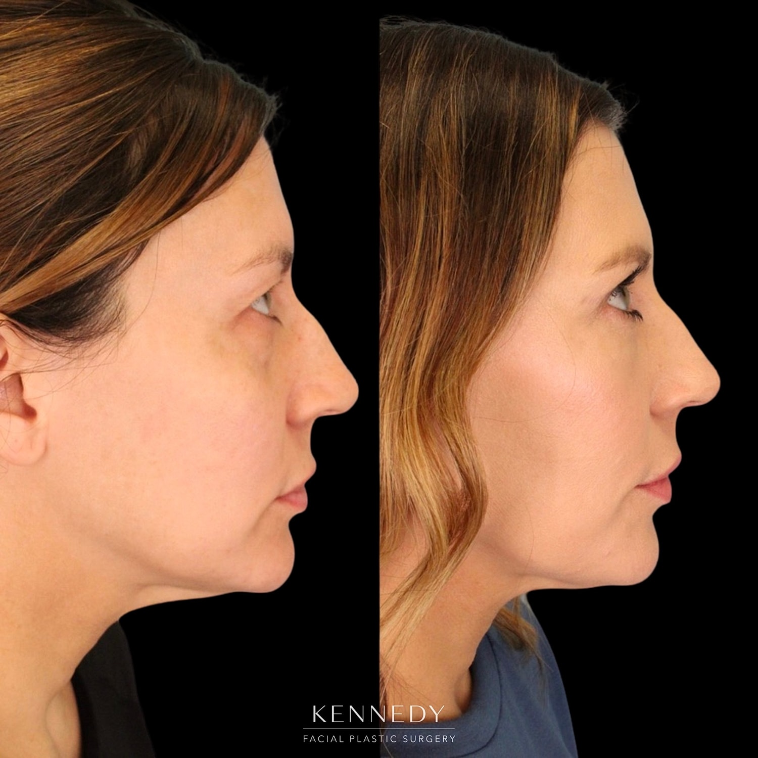 Lower Blepharoplasty Before & After
