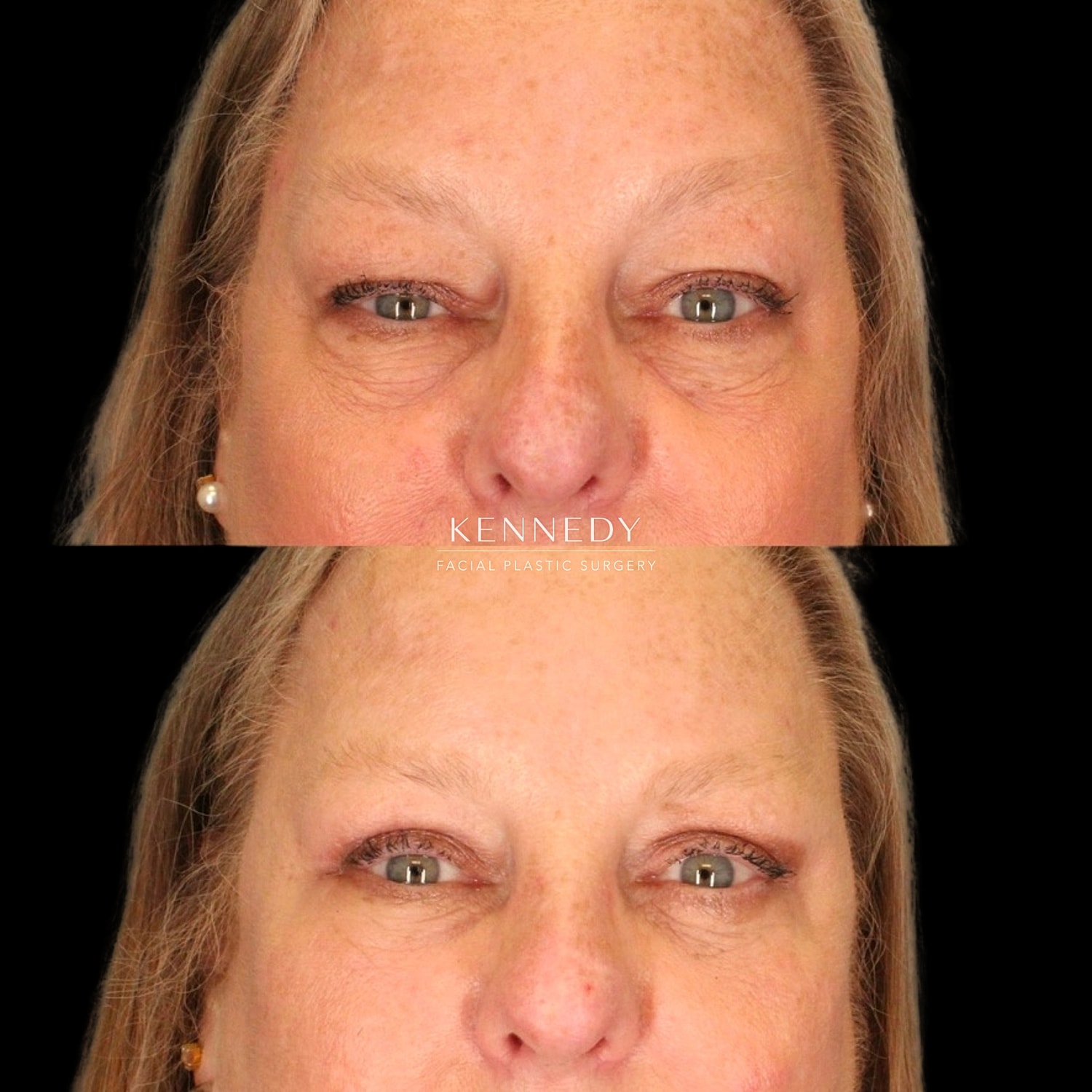 Lower Blepharoplasty Before & After