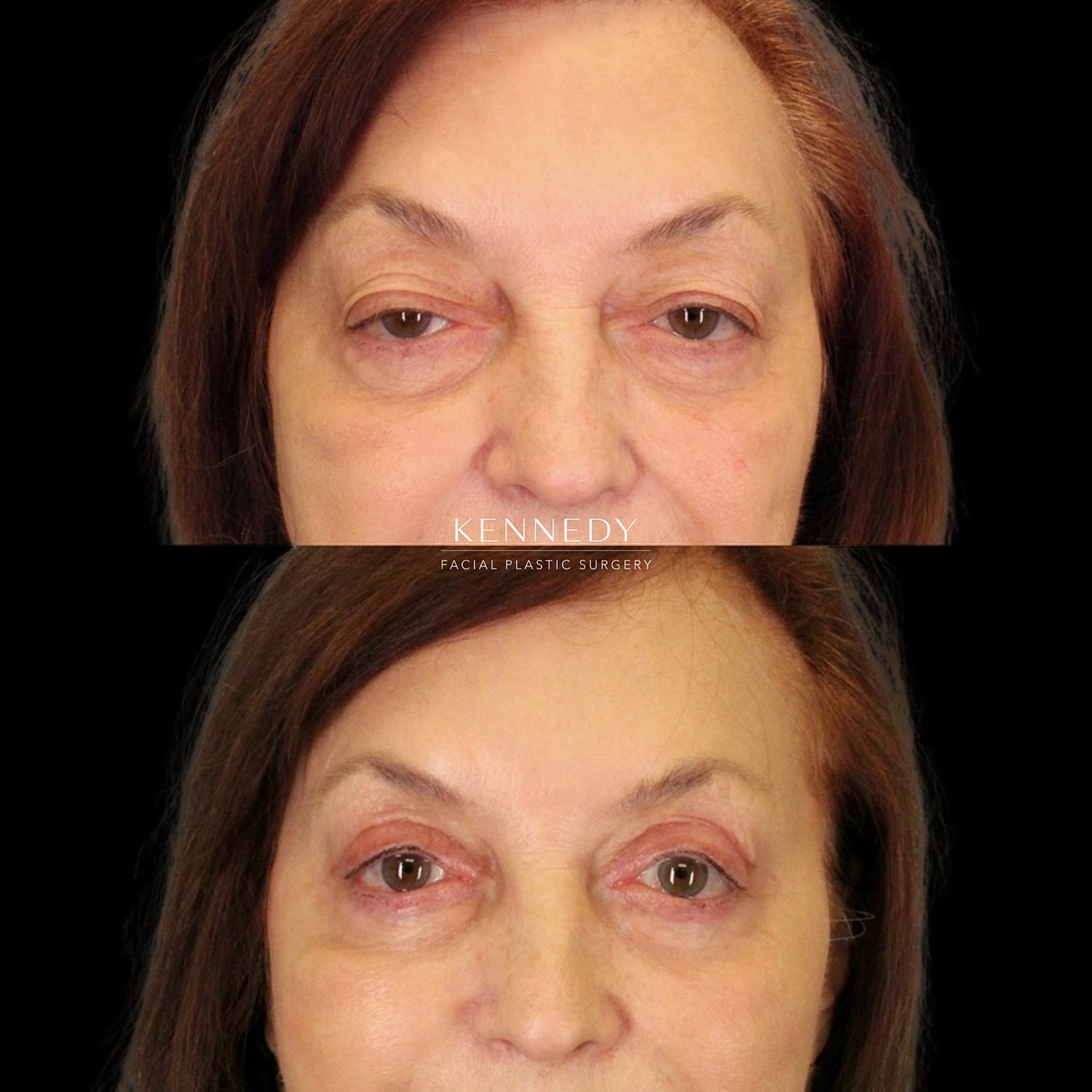 Upper Blepharoplasty Before & After