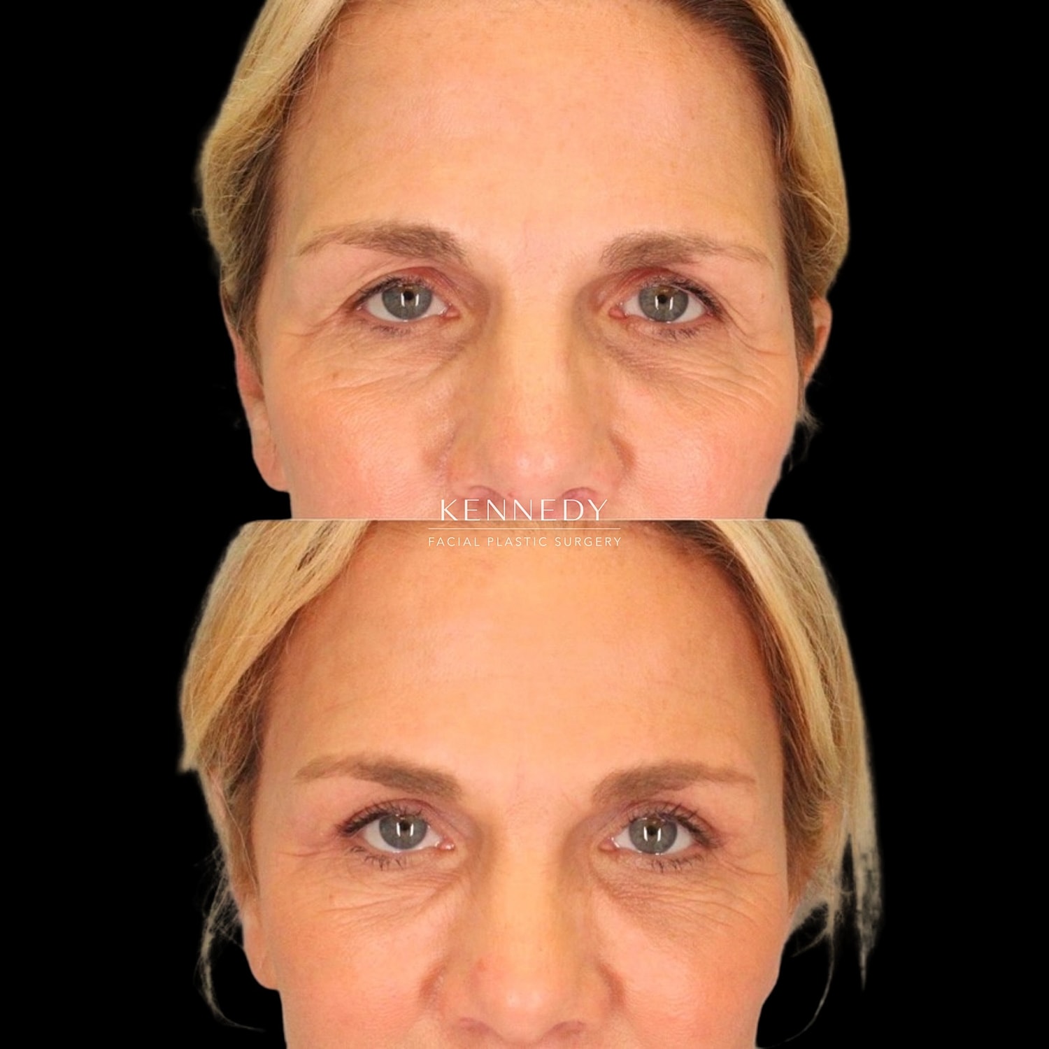 Upper Blepharoplasty Before & After