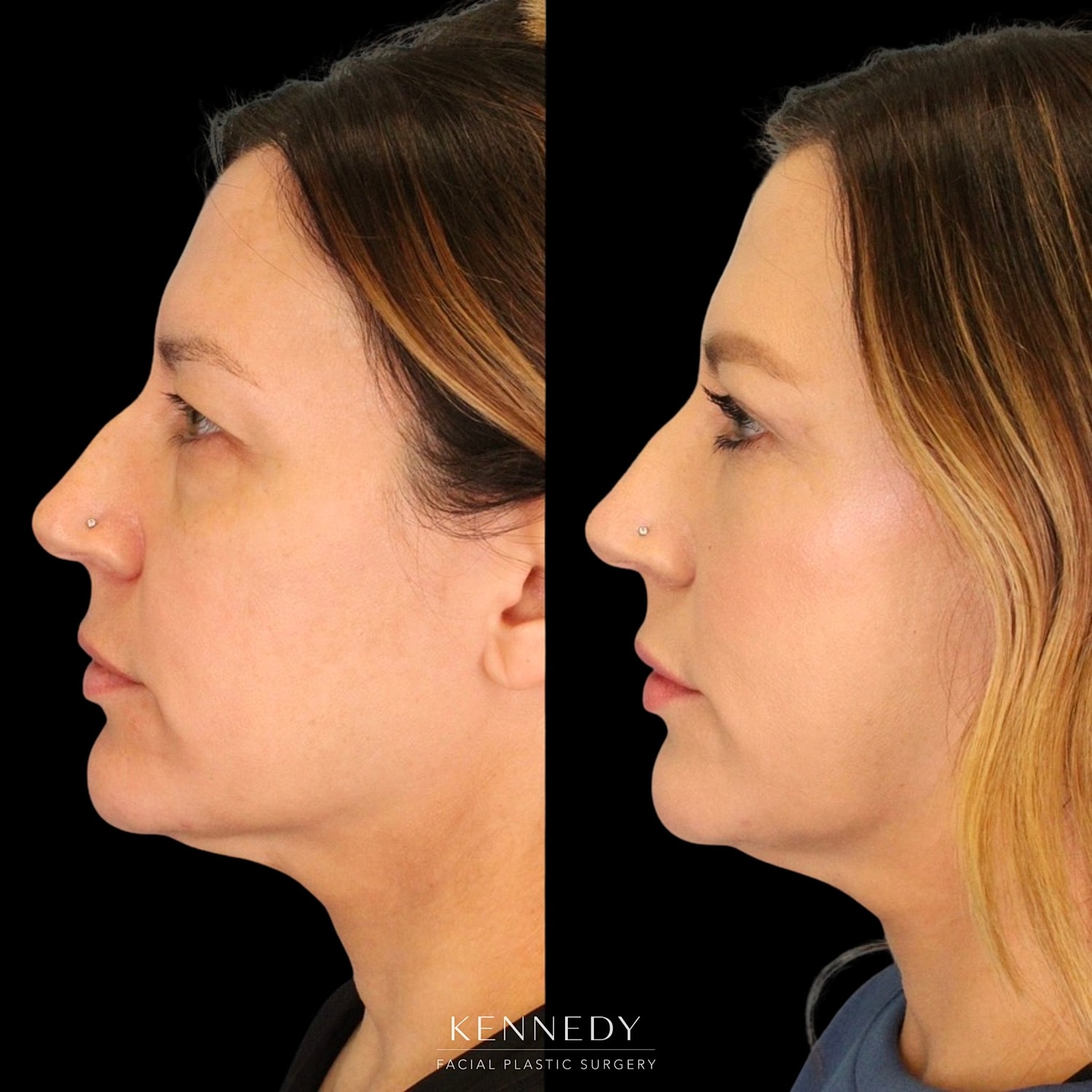 Upper Blepharoplasty Before & After