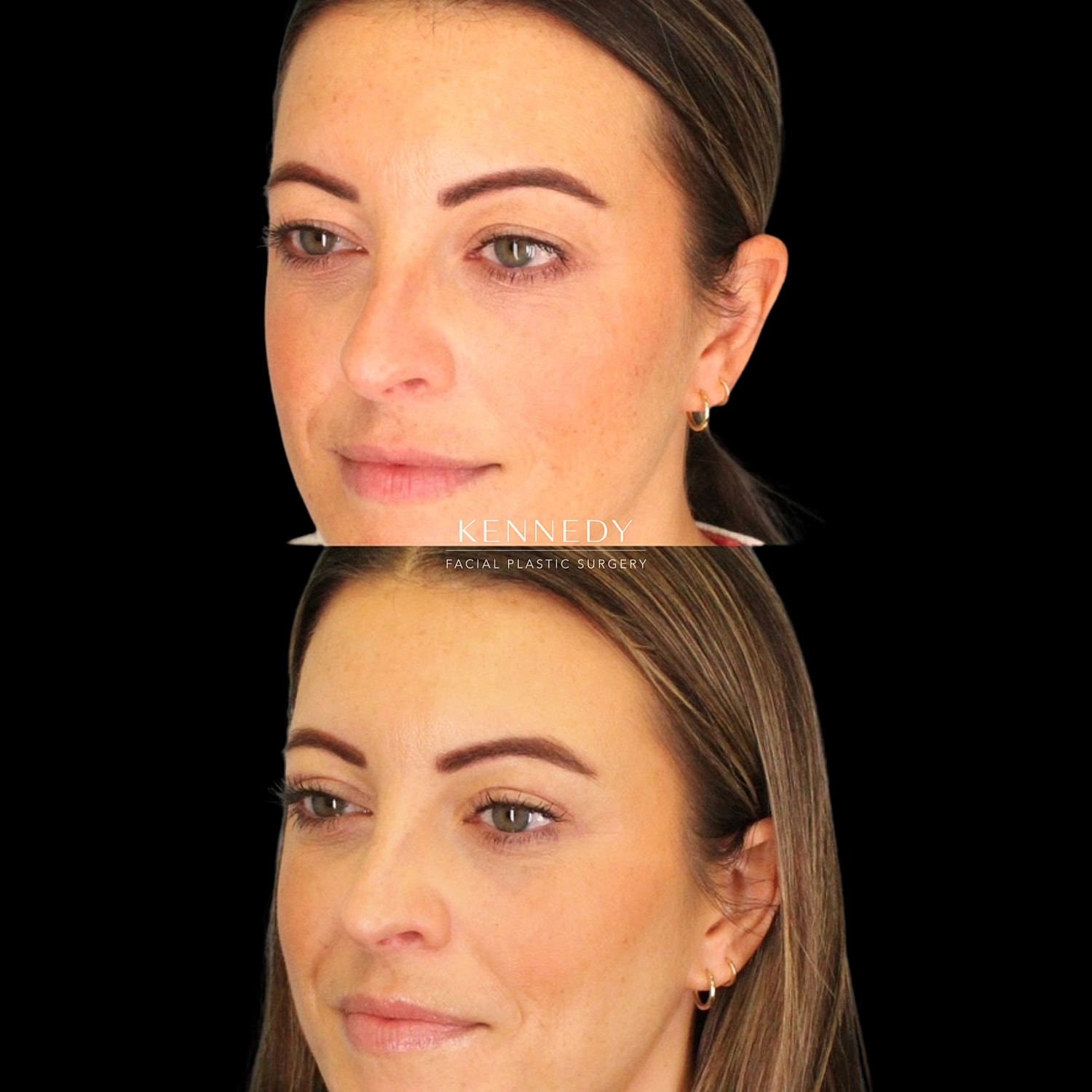 Upper Blepharoplasty Before & After