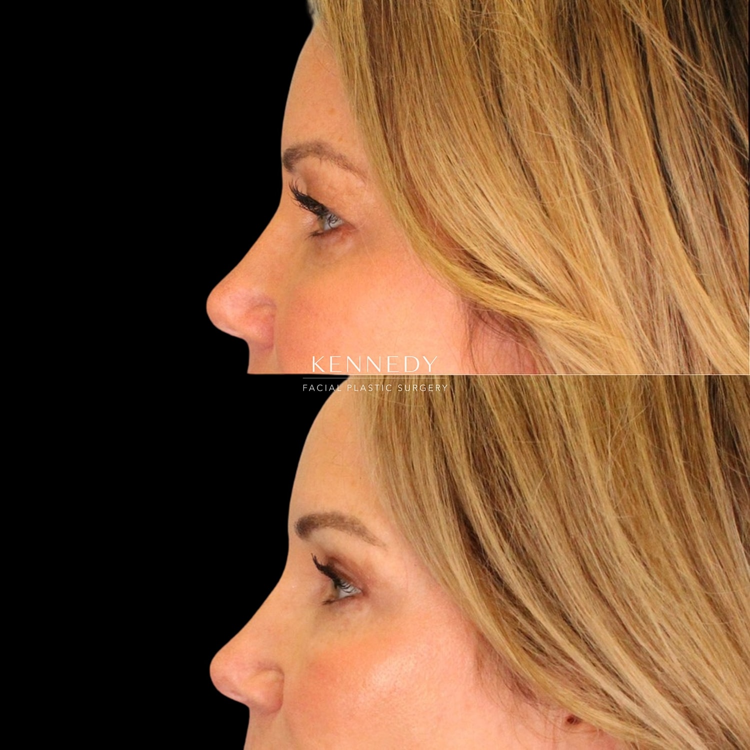 Upper Blepharoplasty Before & After