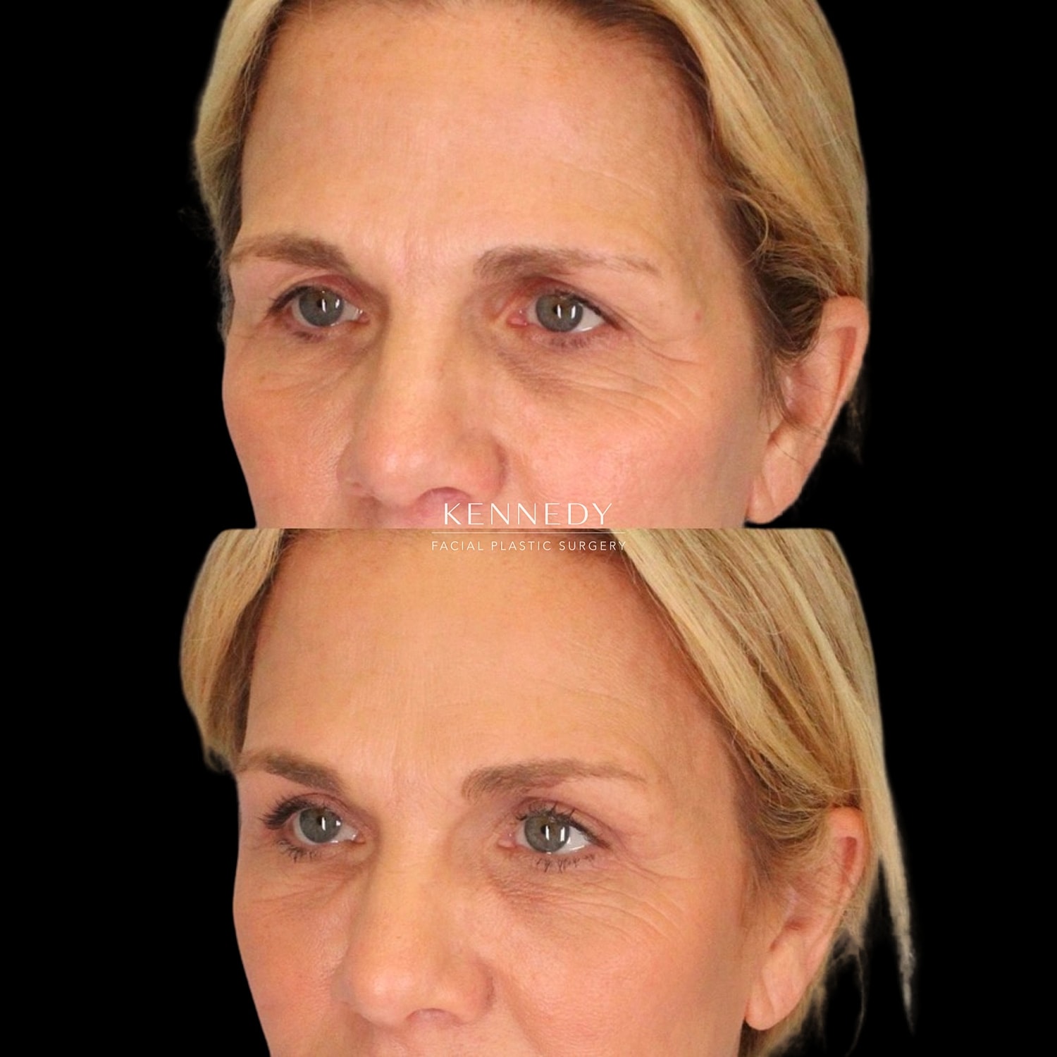 Upper Blepharoplasty Before & After
