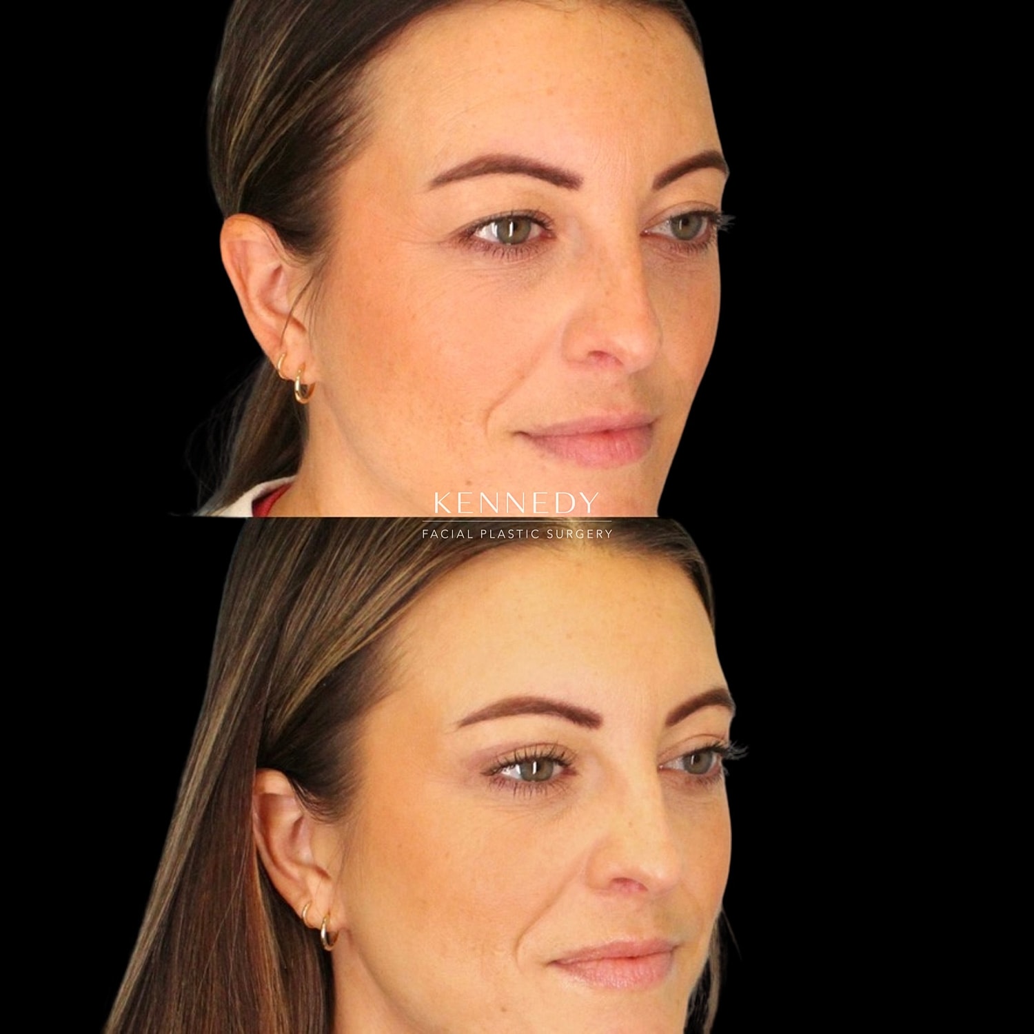 Upper Blepharoplasty Before & After