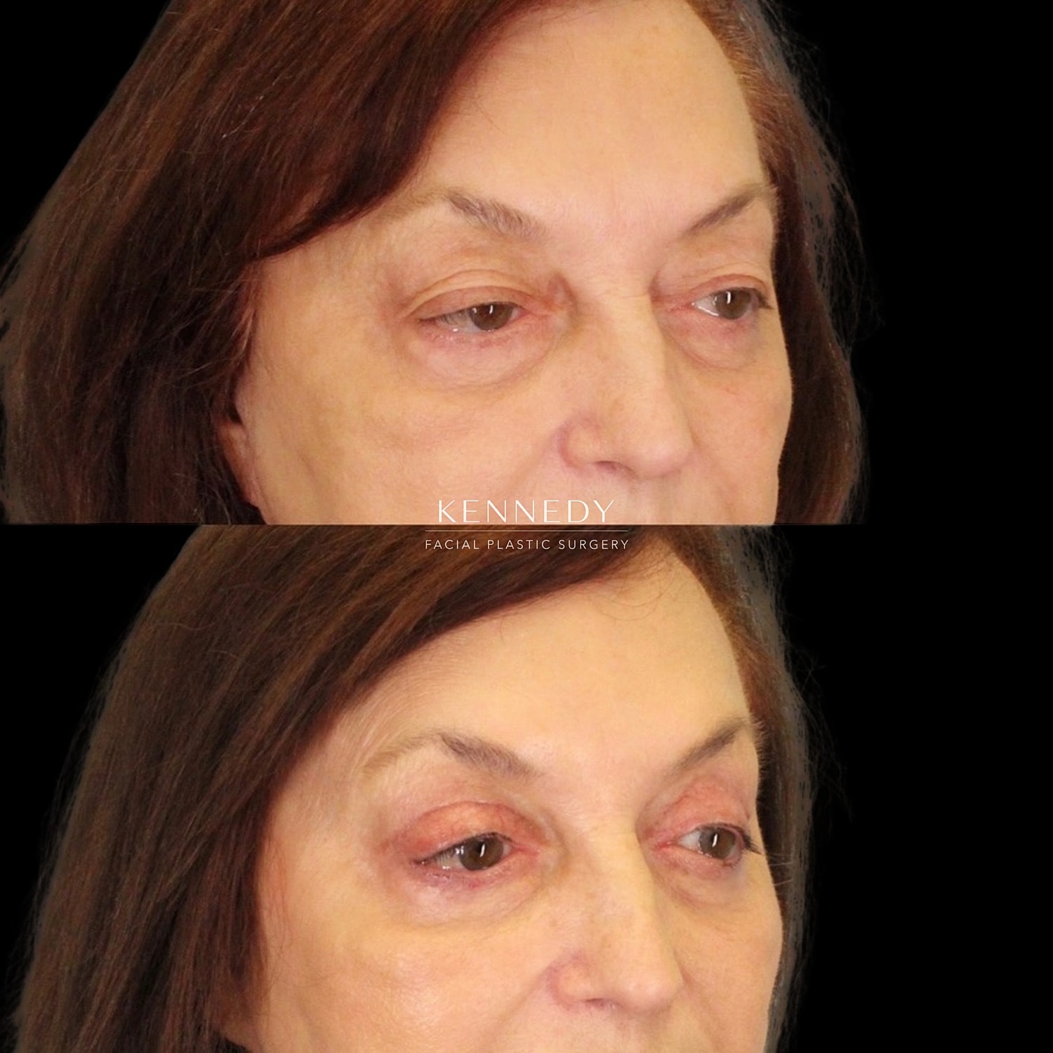 Upper Blepharoplasty Before & After