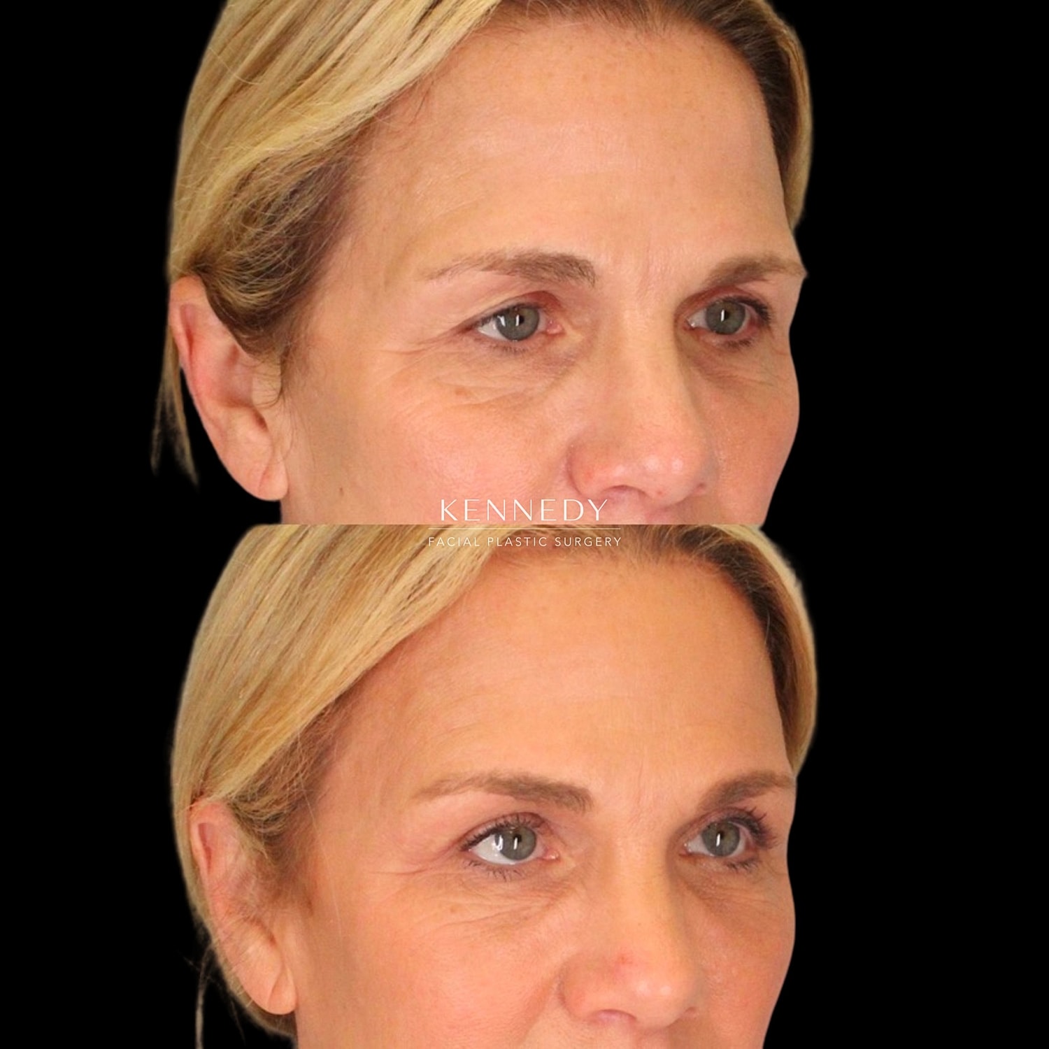 Upper Blepharoplasty Before & After