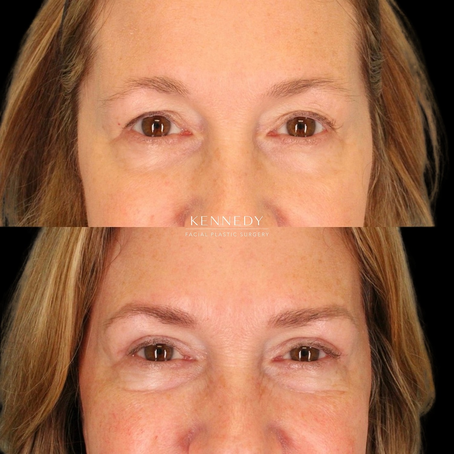 Upper Blepharoplasty Before & After