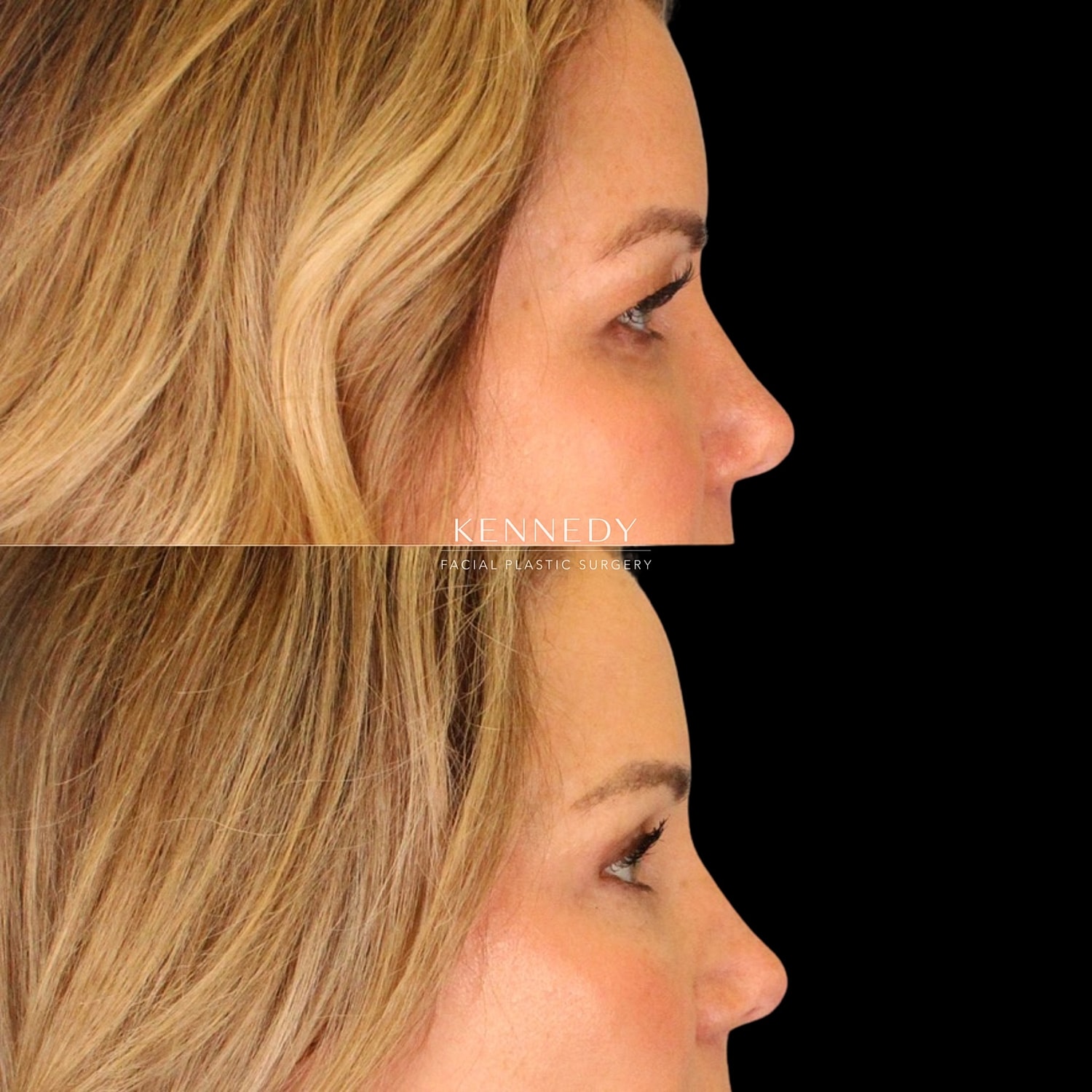 Upper Blepharoplasty Before & After