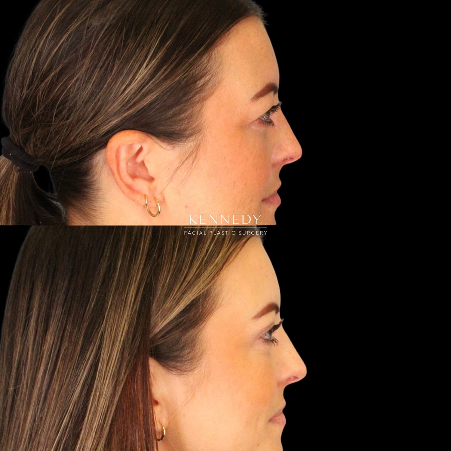Upper Blepharoplasty Before & After
