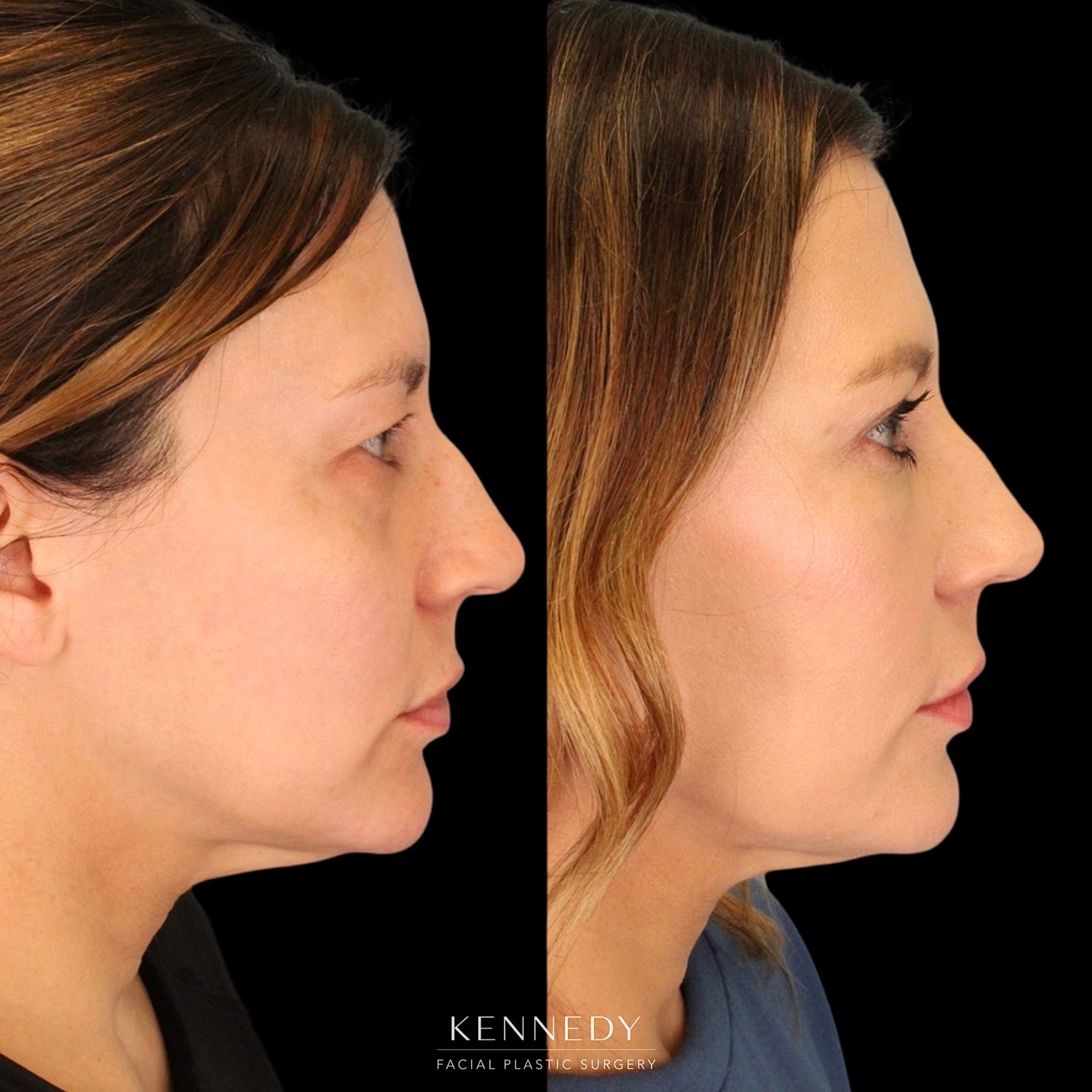 Upper Blepharoplasty Before & After