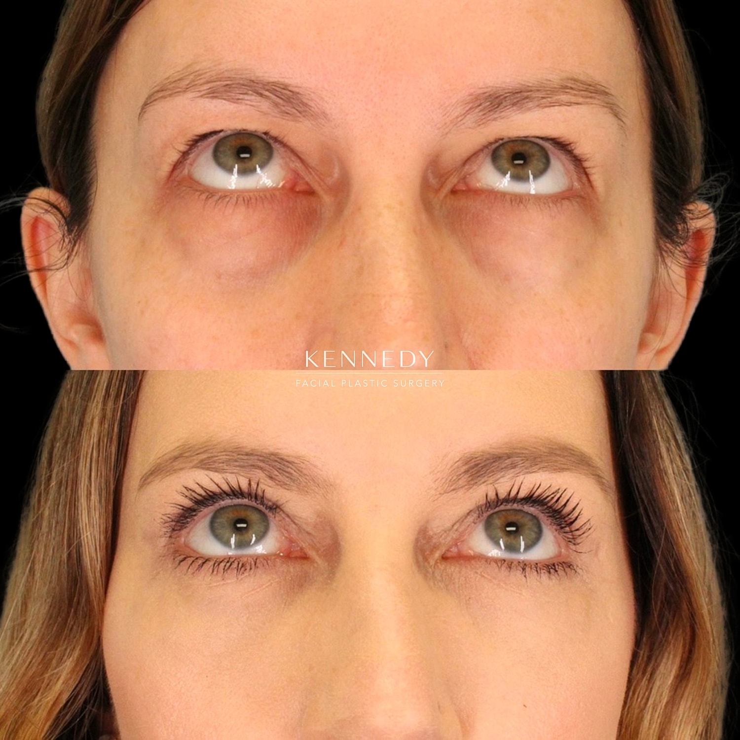 Upper Blepharoplasty Before & After