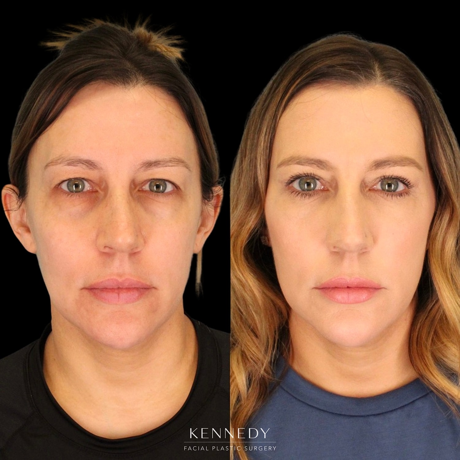 Upper Blepharoplasty Before & After