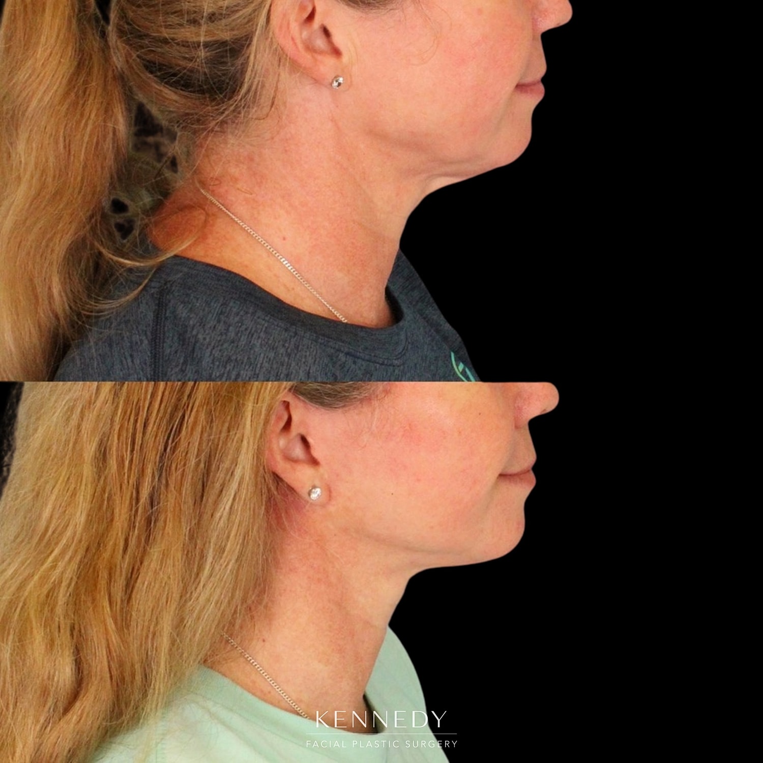 Facelift Before & After