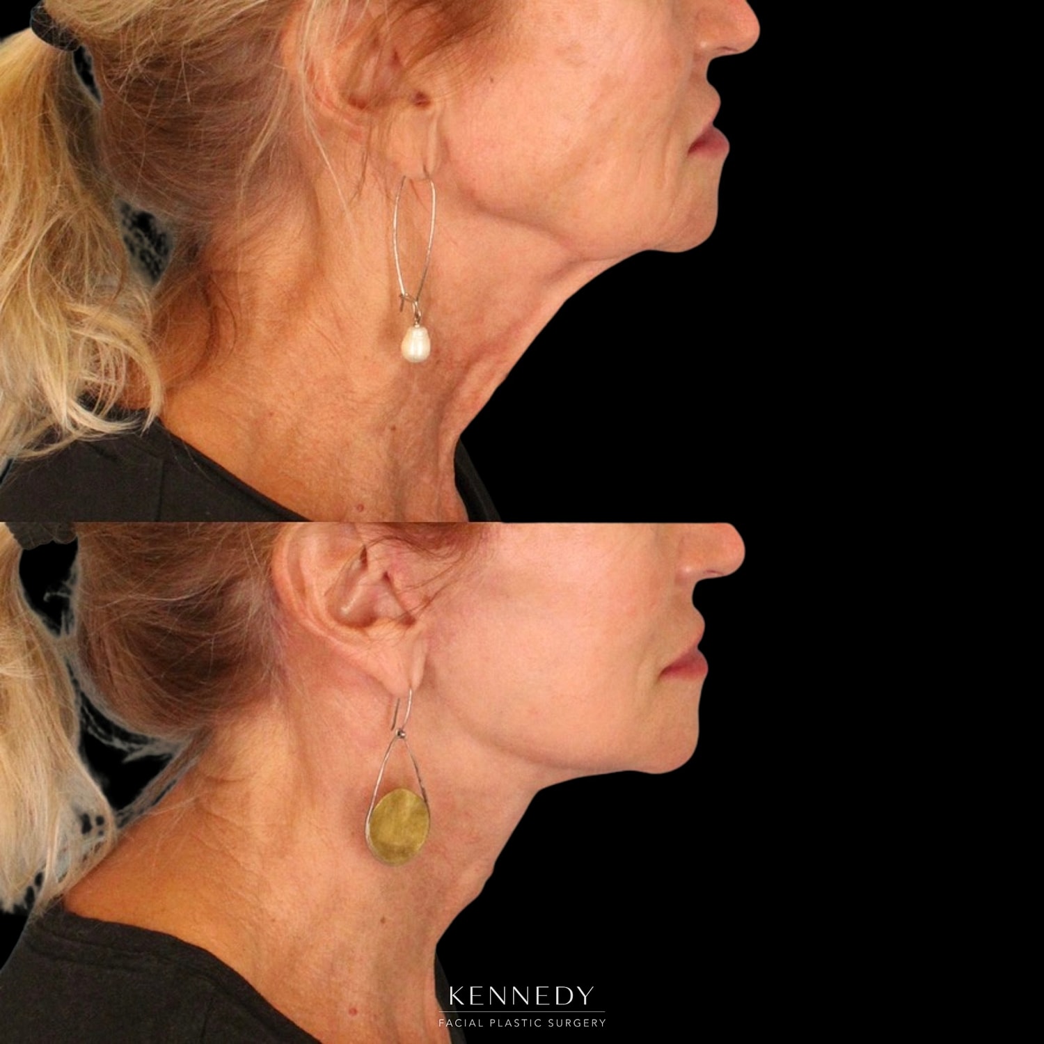 Facelift Before & After