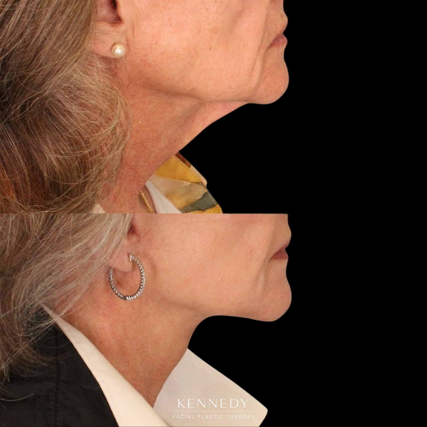 Facelift Before & After