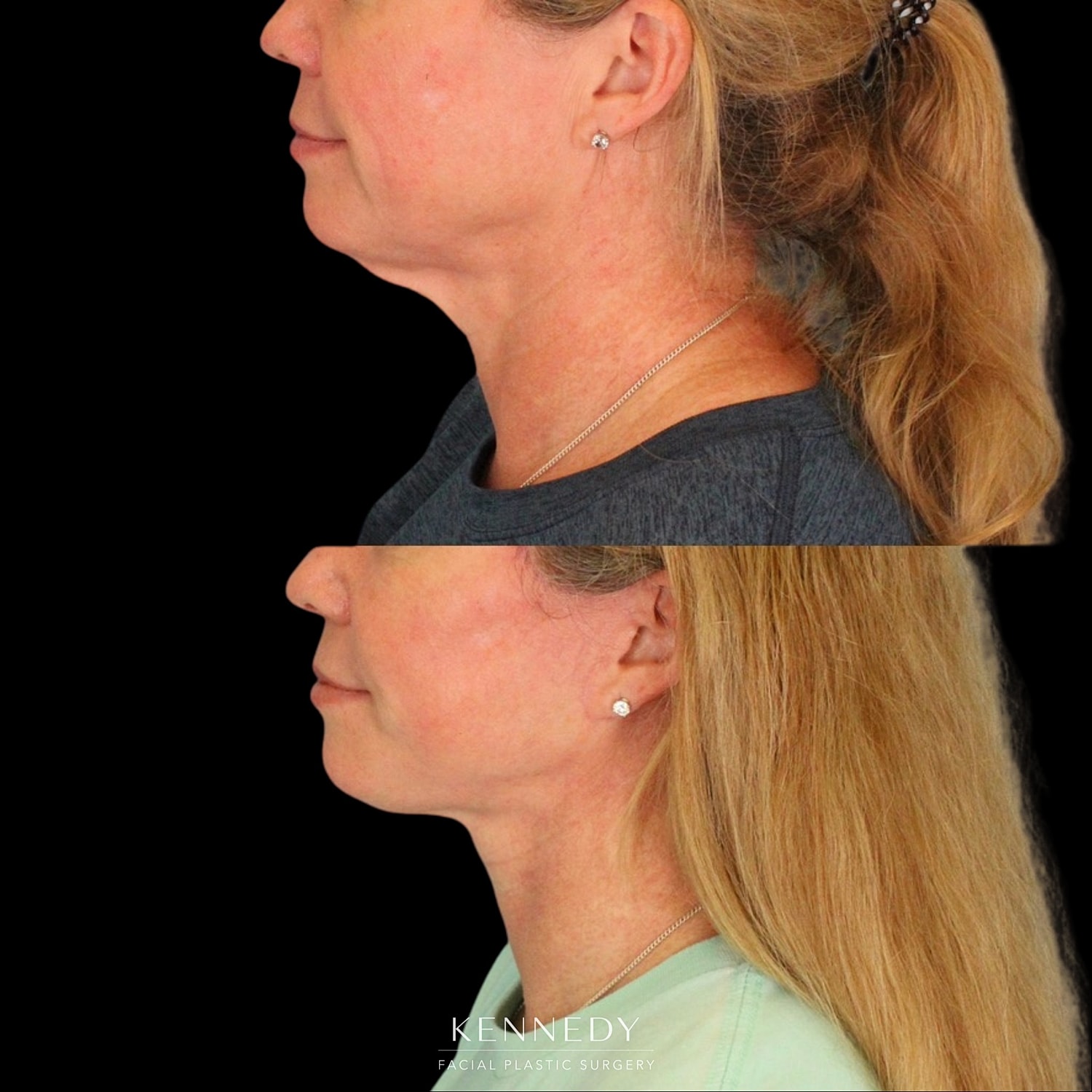 Facelift Before & After