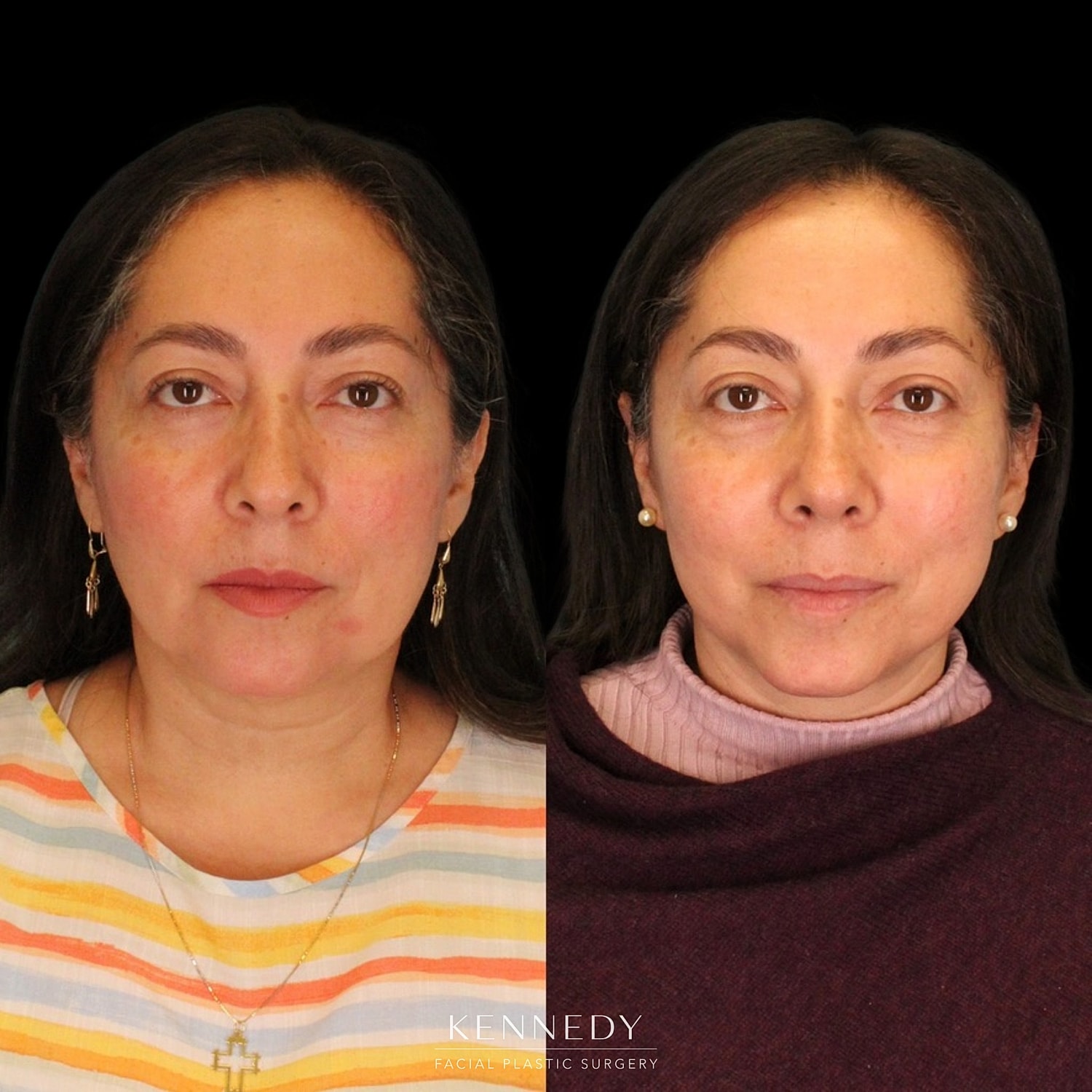 Facelift Before & After