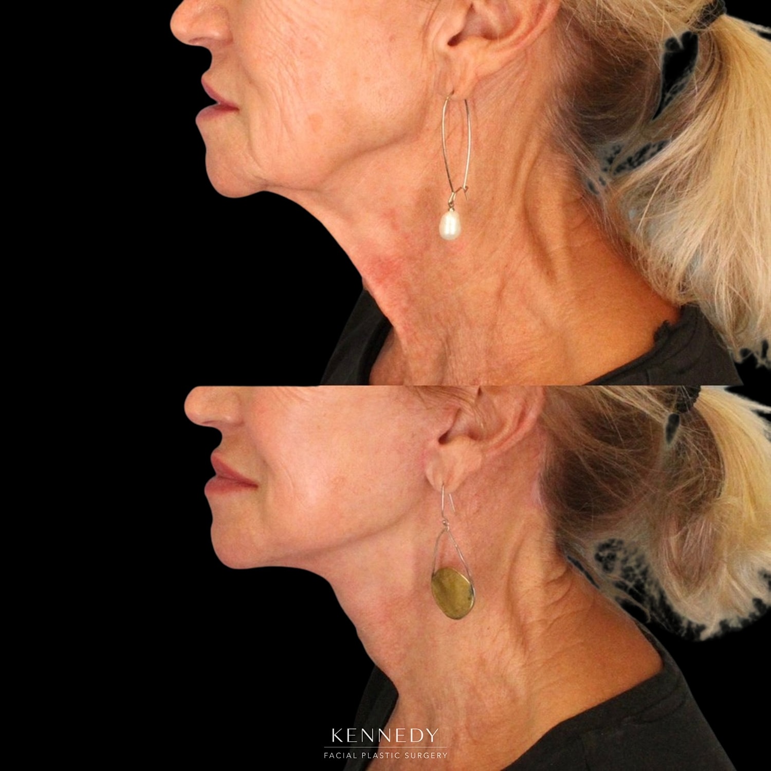Facelift Before & After