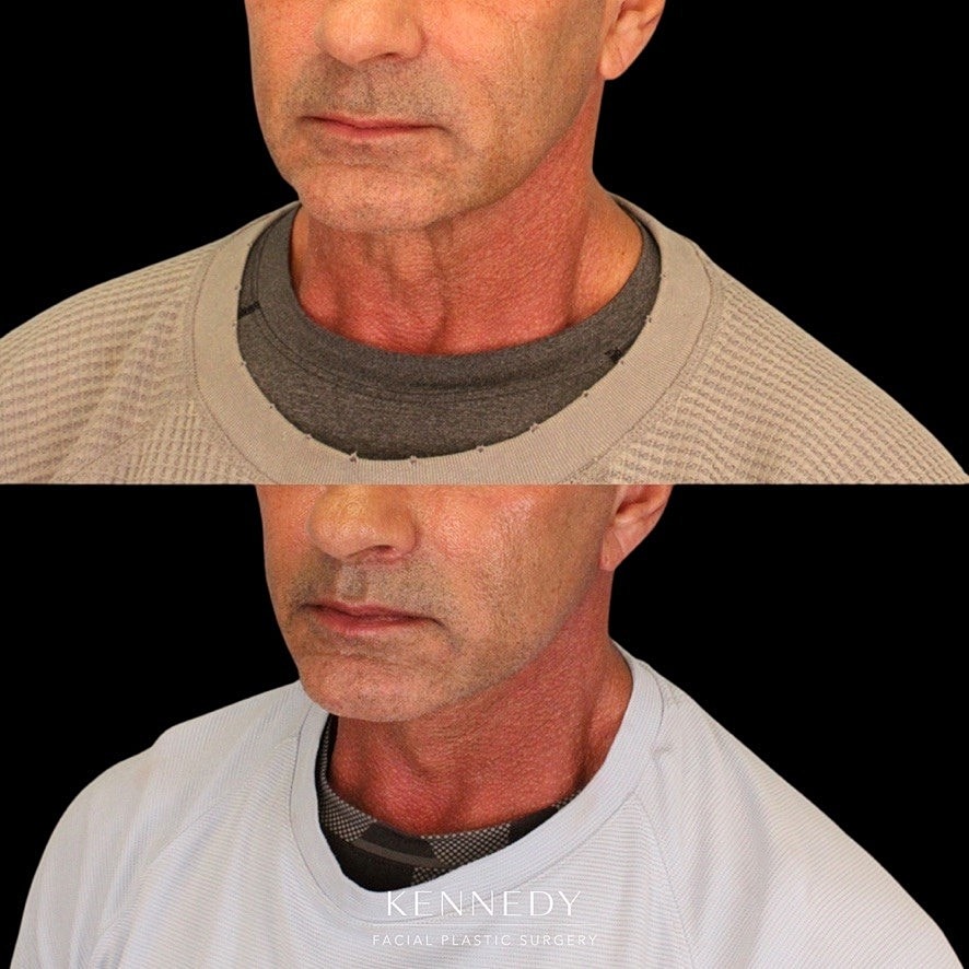 Facelift Before & After